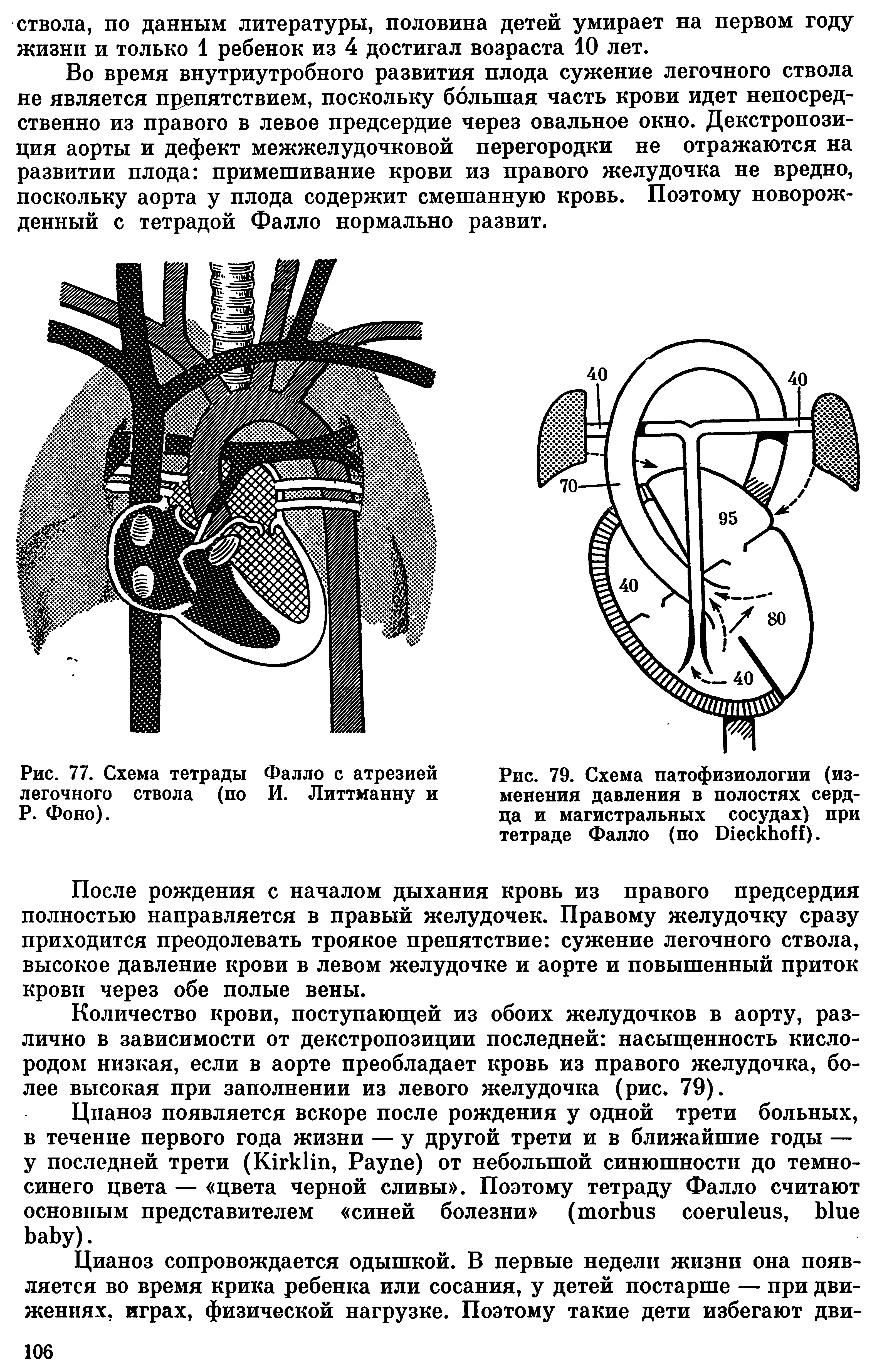 Рис. 79. Схема патофизиологии (изменения давления в полостях сердца и магистральных сосудах) при тетраде Фалло (по В1ескЬо ).