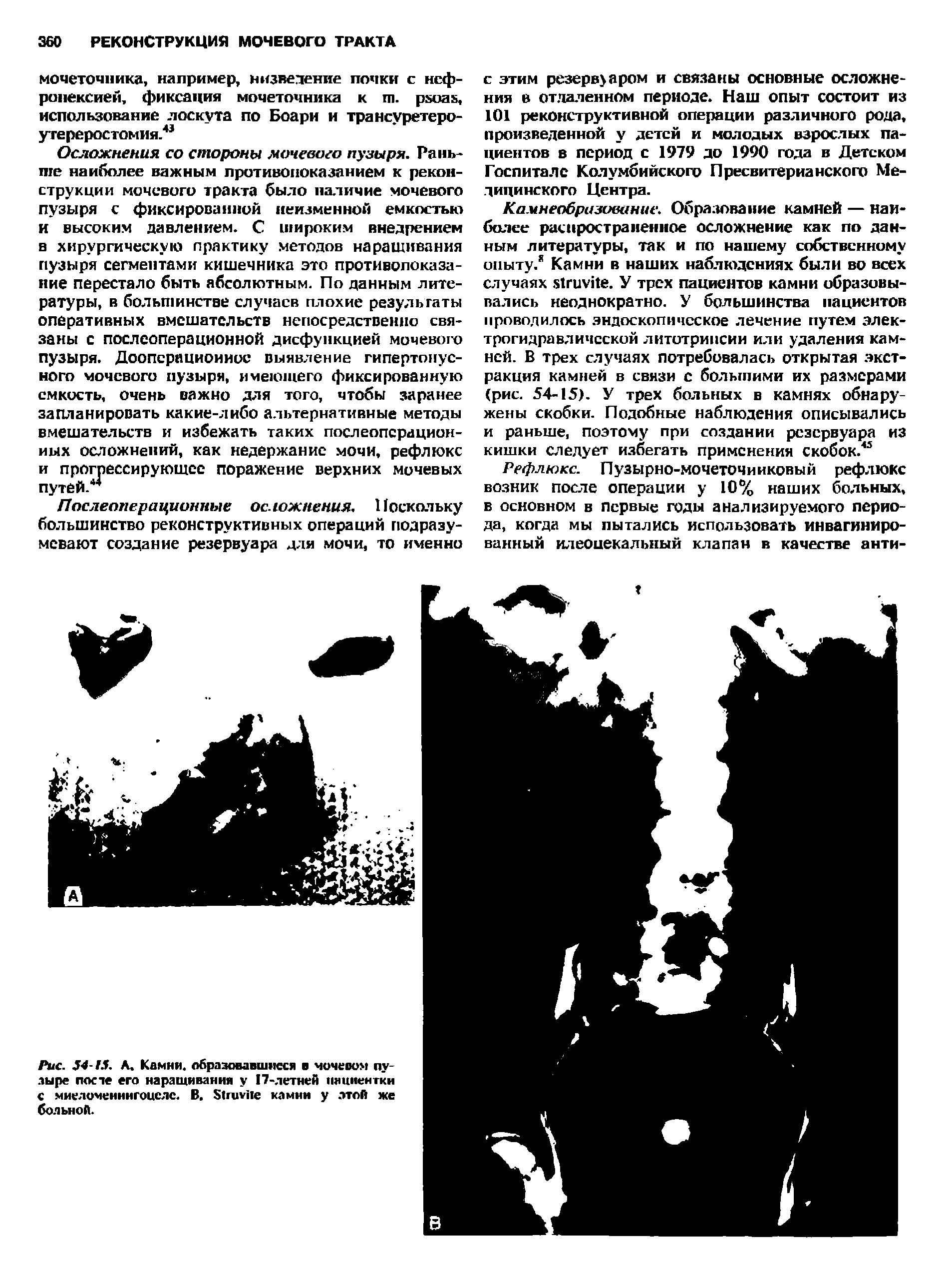 Рис. 4 0. А. Камня, образовавшиеся в чочеоом пузыре после его наращивания у 17-летней штиентки с миеломенингоцеле. В. 1ппг е камни у этой же больной.