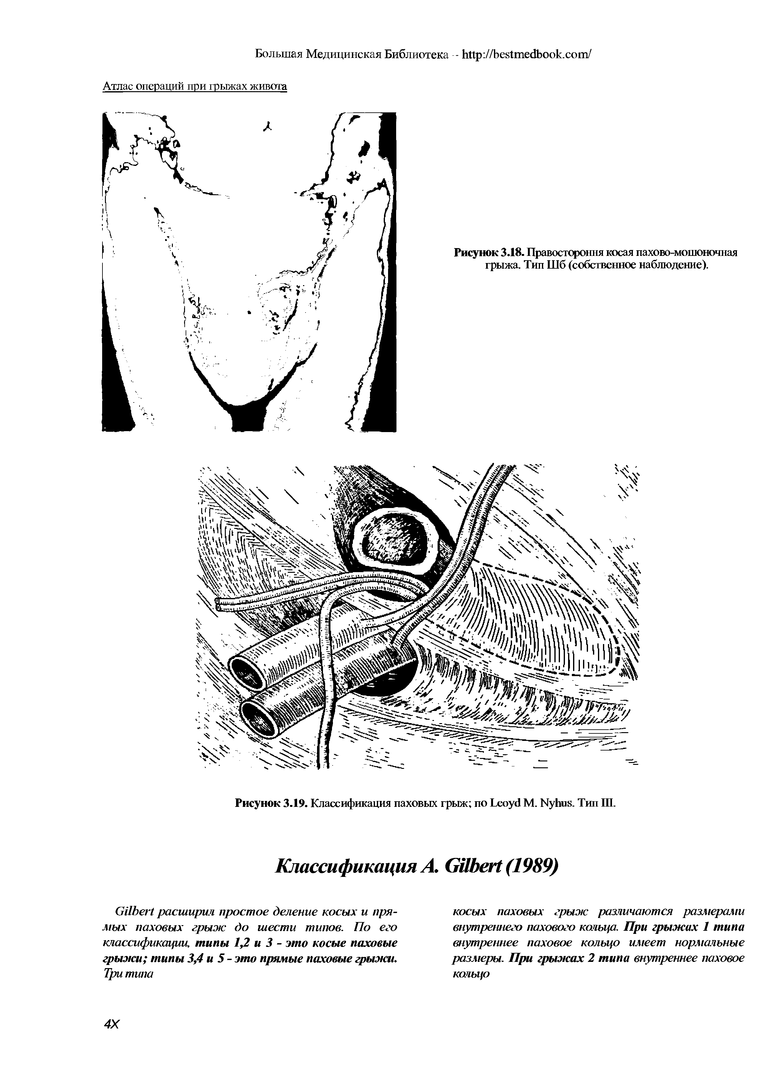 Рисунок 3.19. Классификация паховых грыж по L М. N . Тип Ш.