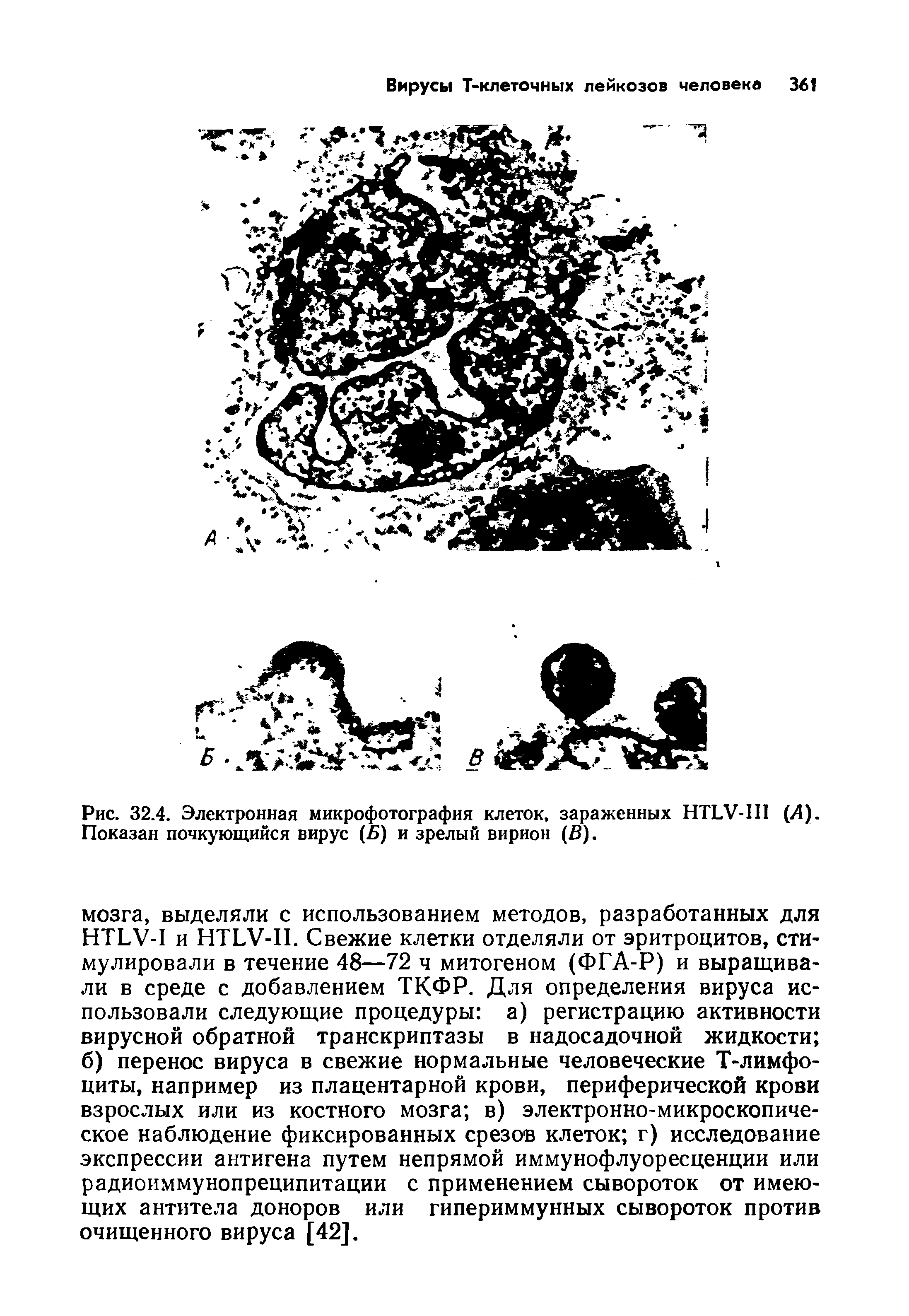 Рис. 32.4. Электронная микрофотография клеток, зараженных НТЬУ-Ш (Л). Показан почкующийся вирус (Б) и зрелый вирион (Б).