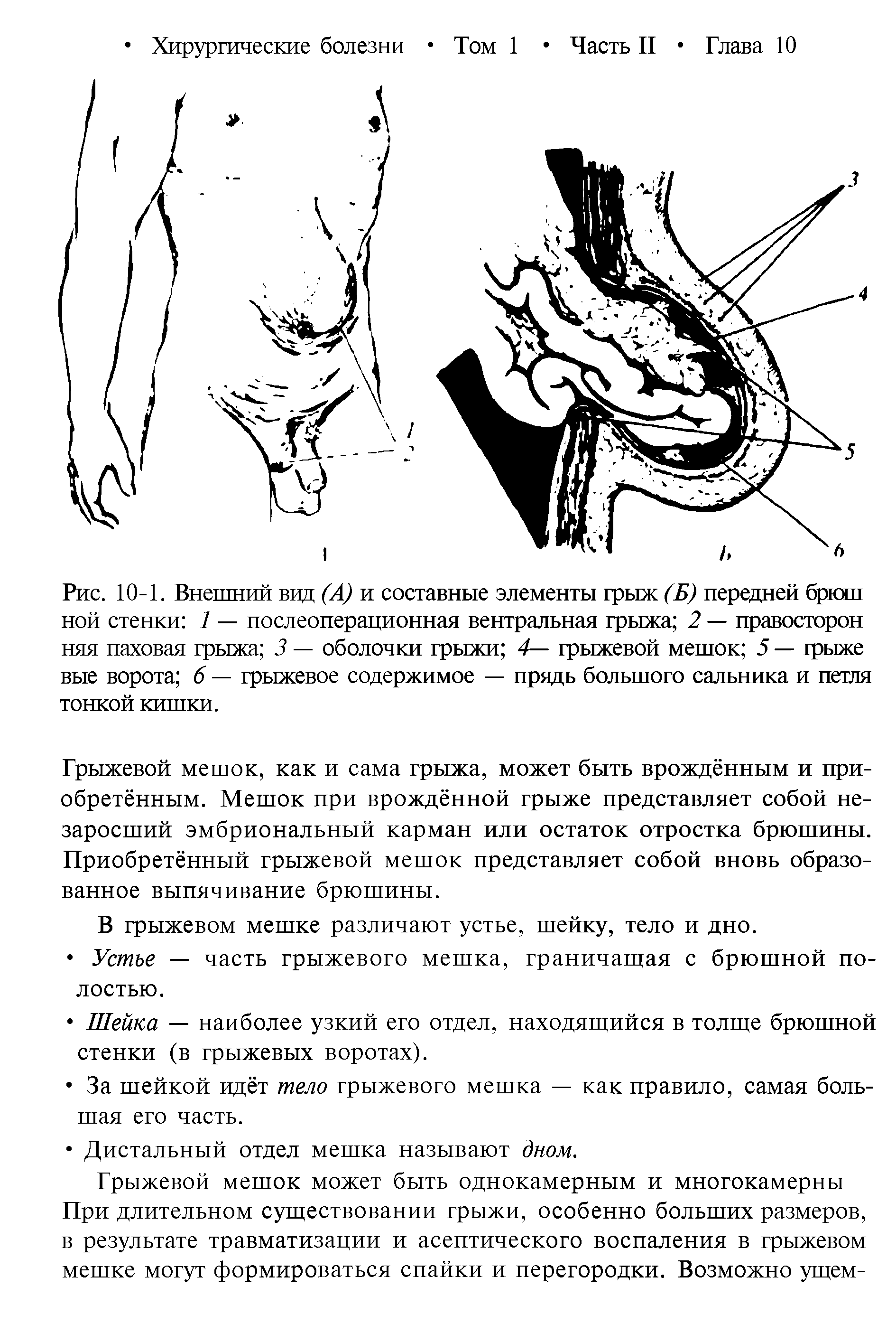 Рис. 10-1. Внешний вид (А) и составные элементы грыж (Б) передней брюш ной стенки / — послеоперационная вентральная грыжа 2 — правосторон няя паховая грыжа 3 — оболочки грыжи 4— грыжевой мешок 5 — грыже вые ворота 6 — грыжевое содержимое — прядь большого сальника и петля тонкой кишки.