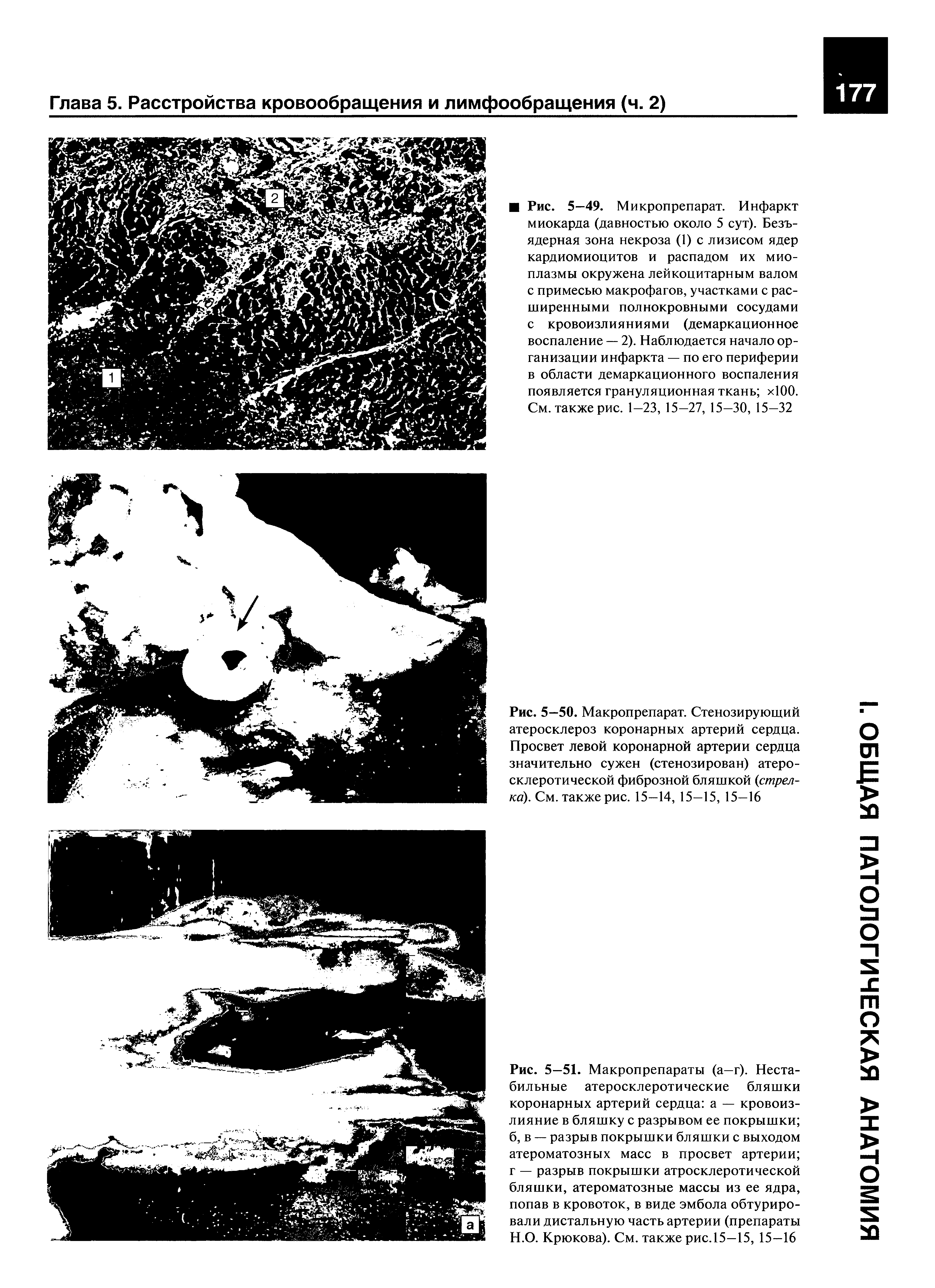 Рис. 5—50. Макропрепарат. Стенозирующий атеросклероз коронарных артерий сердца. Просвет левой коронарной артерии сердца значительно сужен (стенозирован) атеросклеротической фиброзной бляшкой (стрелка). См. также рис. 15—14, 15—15, 15—16...