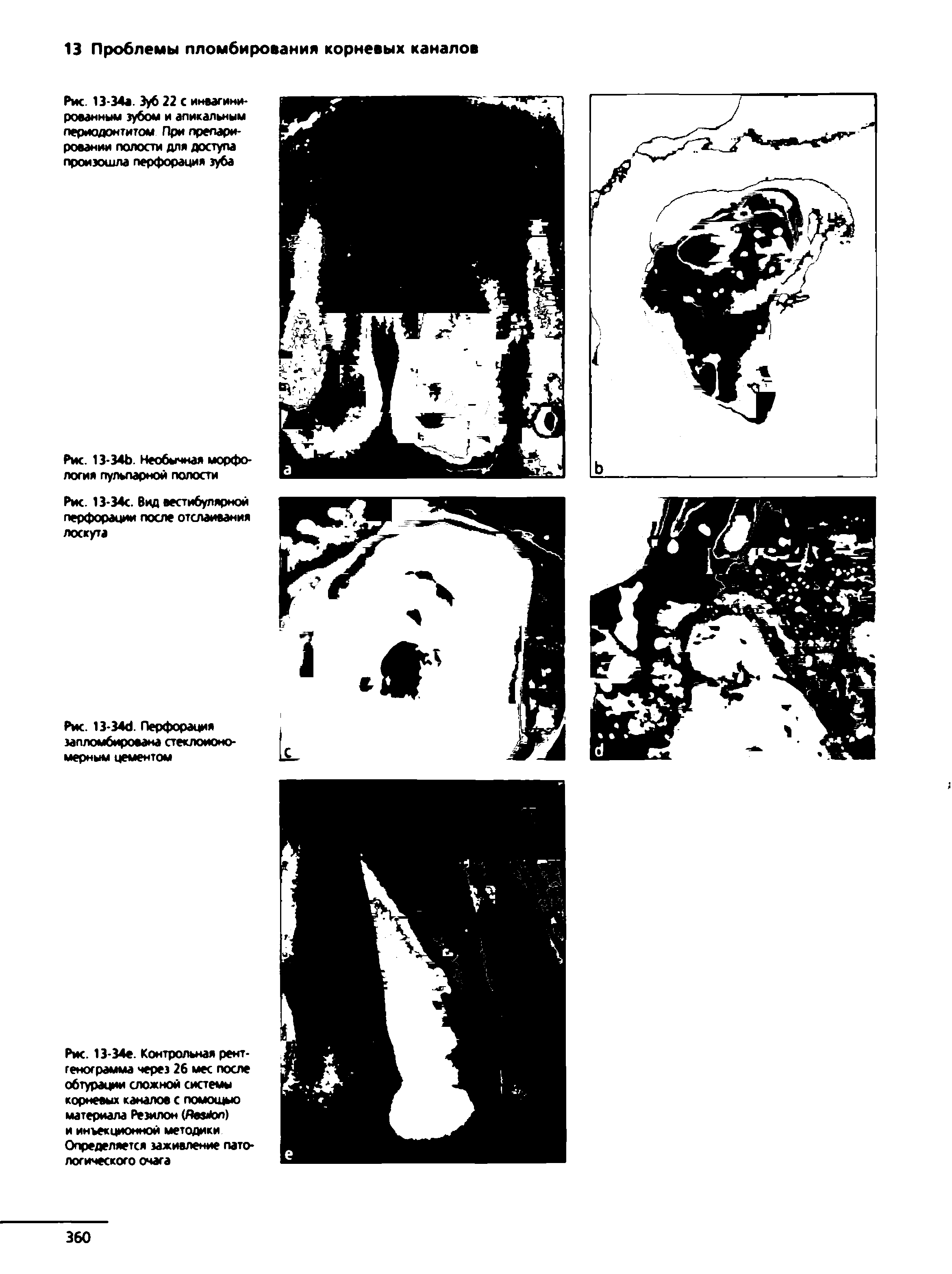 Рис. 13-34а Зуб 22 С инвагини-рованным зубом и апикальным периодонтитом При препарировании полости для доступа произошла перфорация зуба...