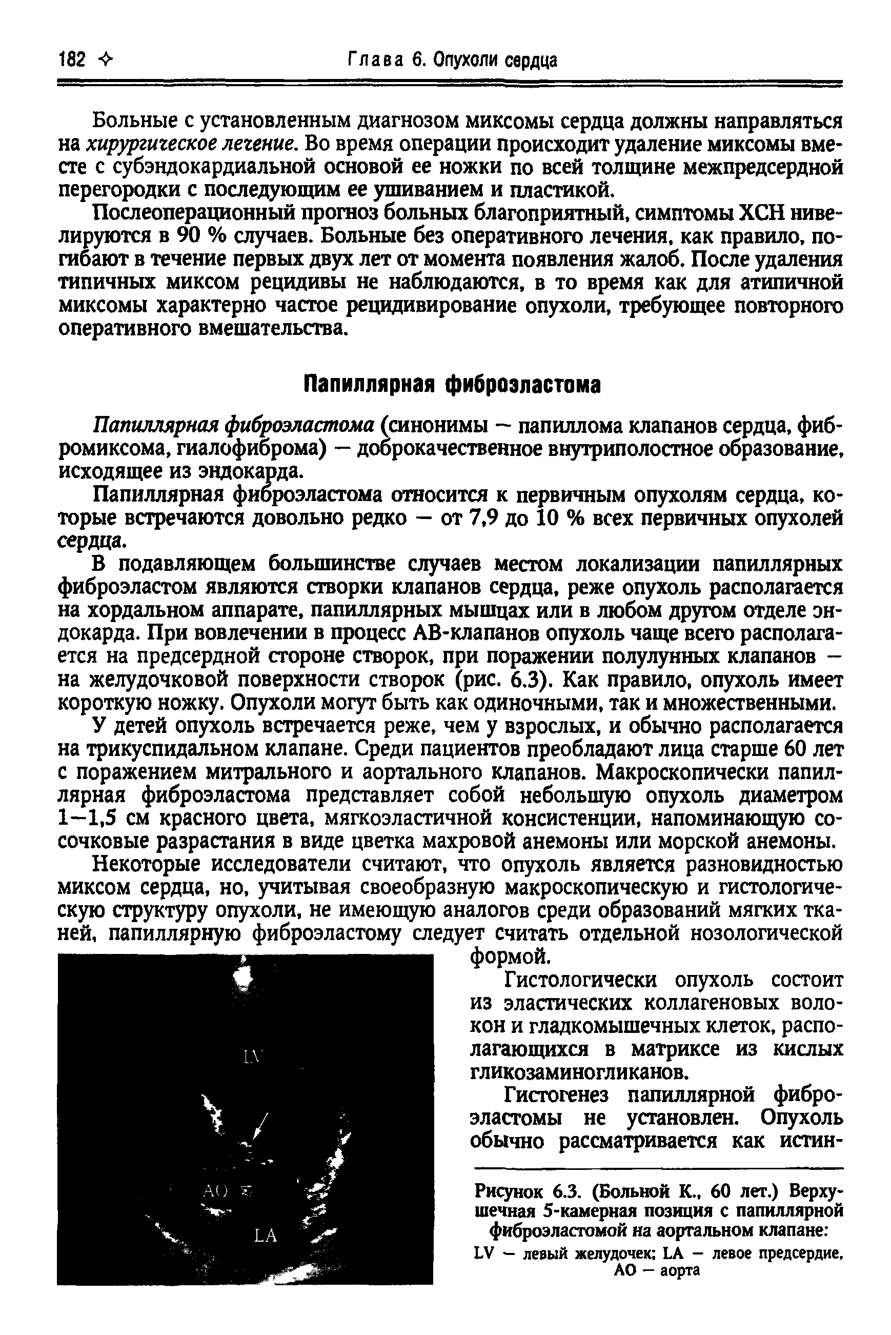 Рисунок 6.3. (Больной К., 60 лет.) Верхушечная 5-камерная позиция с папиллярной фиброэластомой на аортальном клапане ...