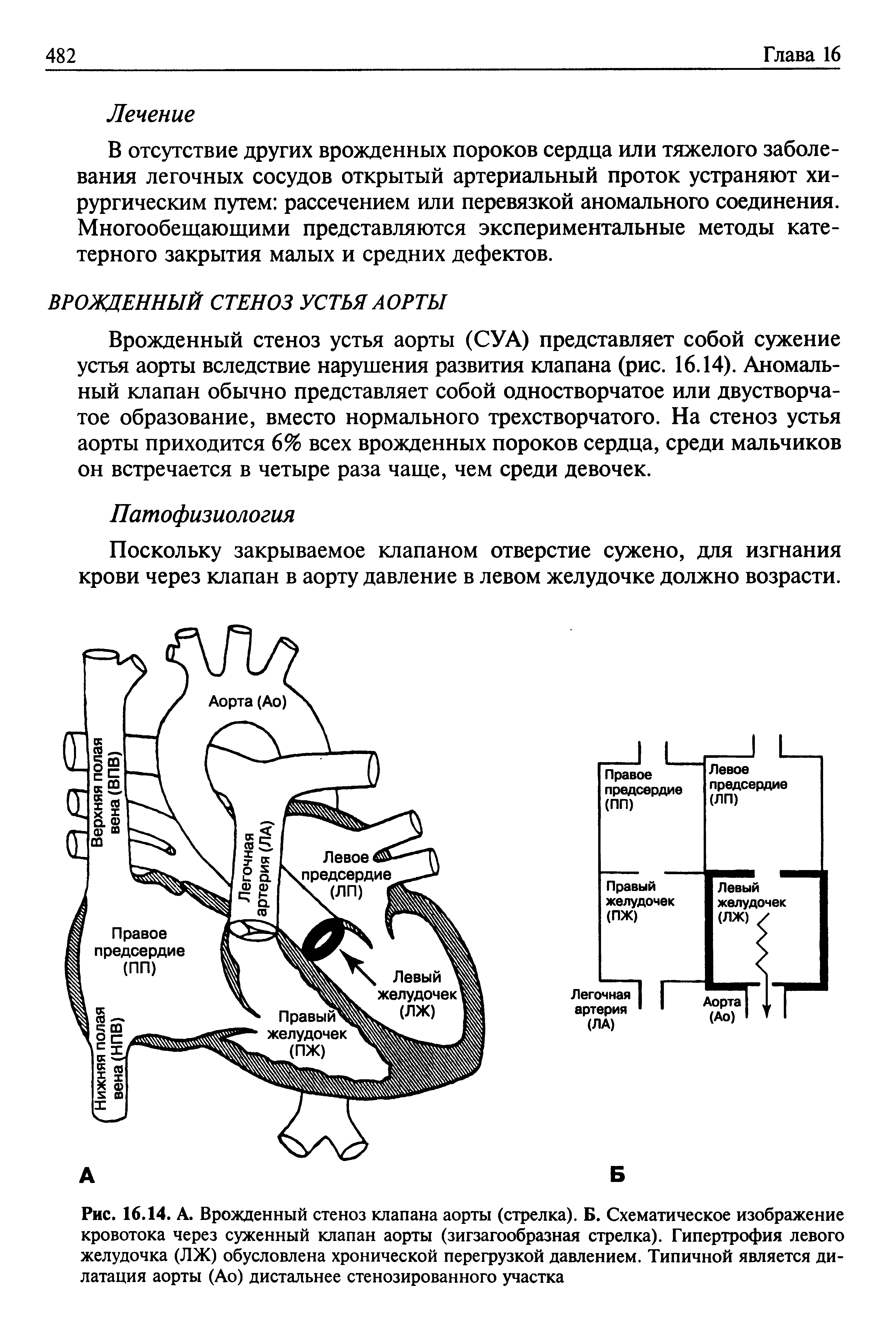 Рис. 16.14. А. Врожденный стеноз клапана аорты (стрелка). Б. Схематическое изображение кровотока через суженный клапан аорты (зигзагообразная стрелка). Гипертрофия левого желудочка (ЛЖ) обусловлена хронической перегрузкой давлением. Типичной является дилатация аорты (До) дистальнее стенозированного участка...