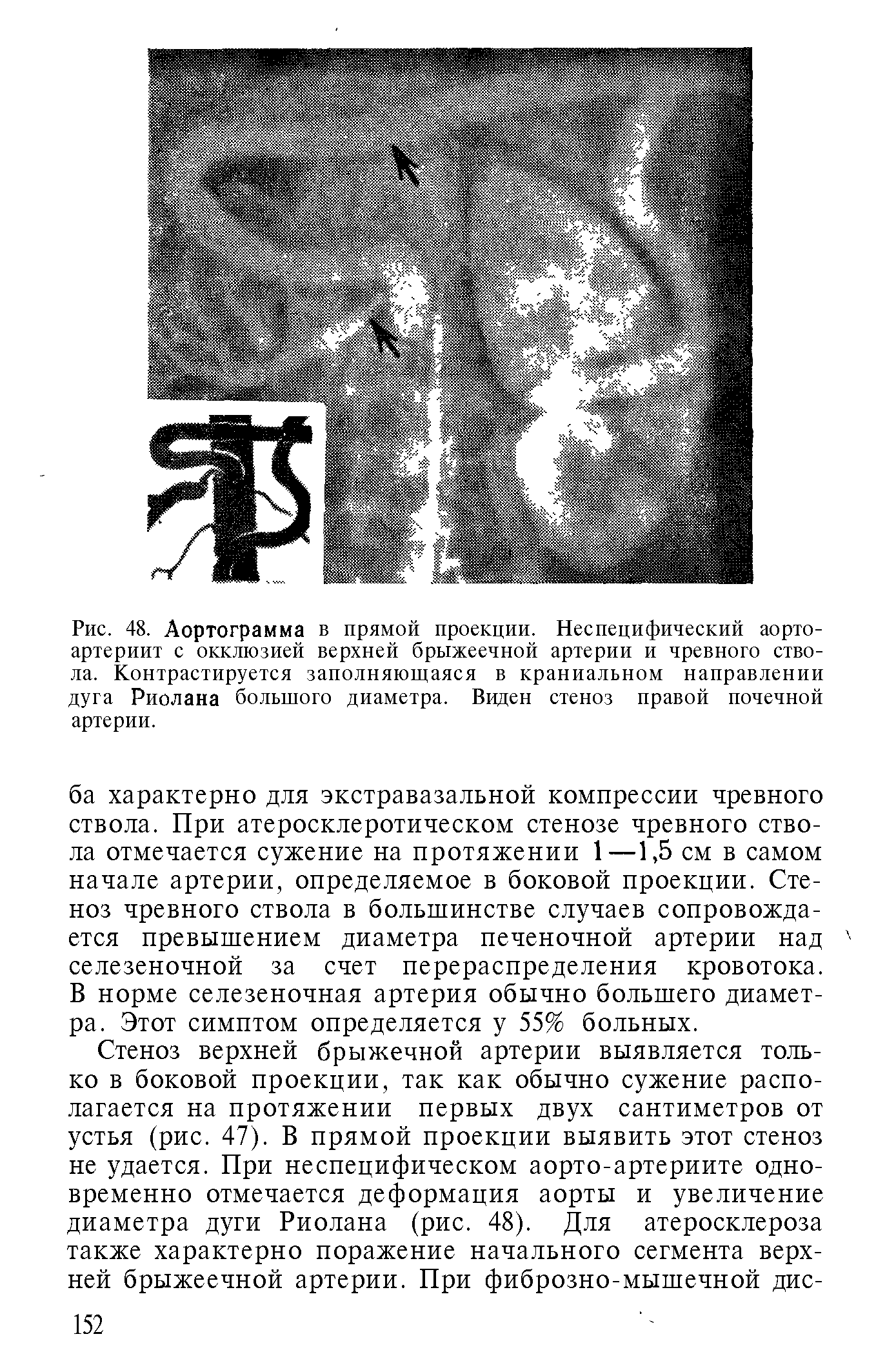 Рис. 48. Аортограмма в прямой проекции. Неспецифический аорто-артериит с окклюзией верхней брыжеечной артерии и чревного ствола. Контрастируется заполняющаяся в краниальном направлении дуга Риолана большого диаметра. Виден стеноз правой почечной артерии.