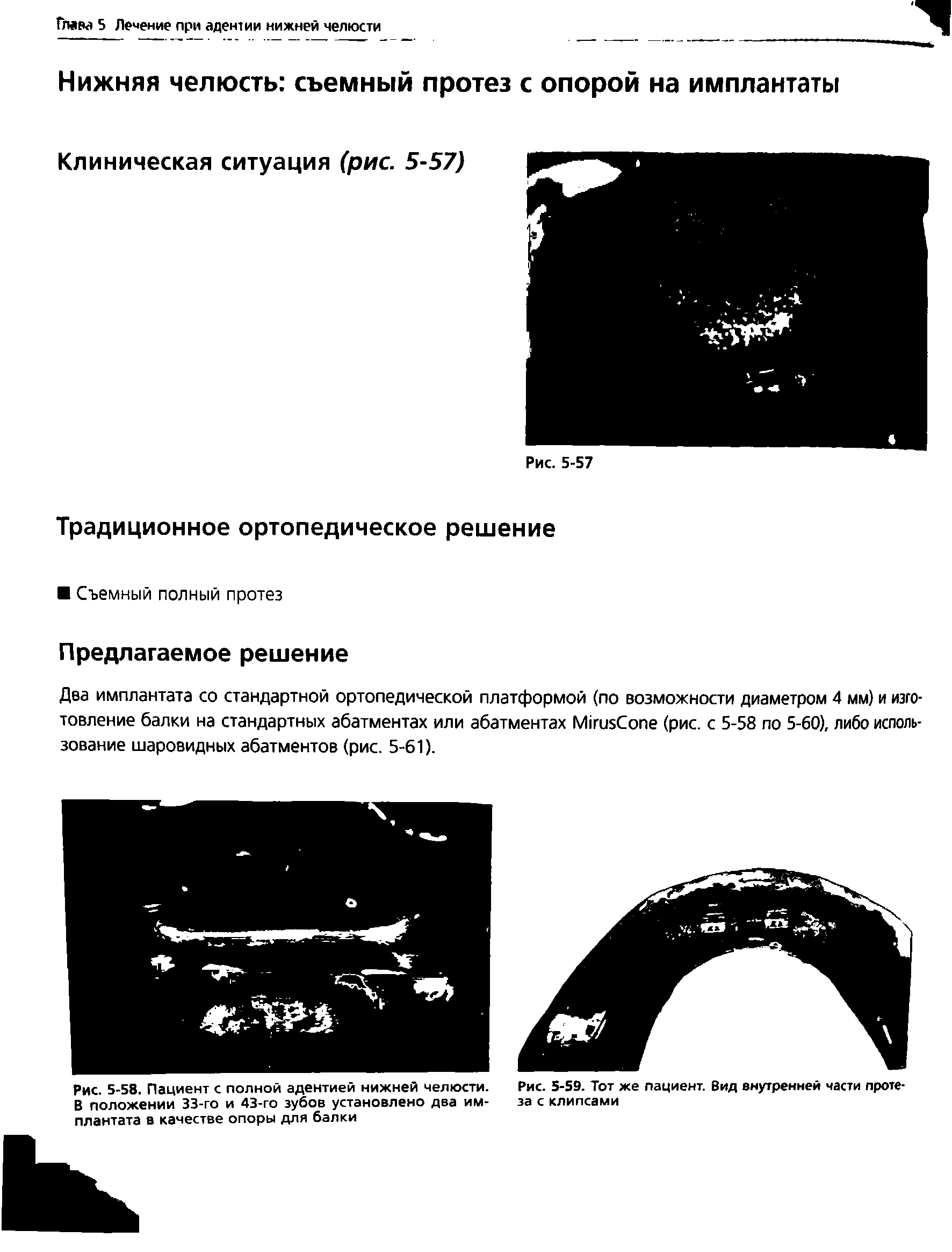 Рис. 5-58. Пациент с полной адентией нижней челюсти. В положении 33-го и 43-го зубов установлено два имплантата в качестве опоры для балки...