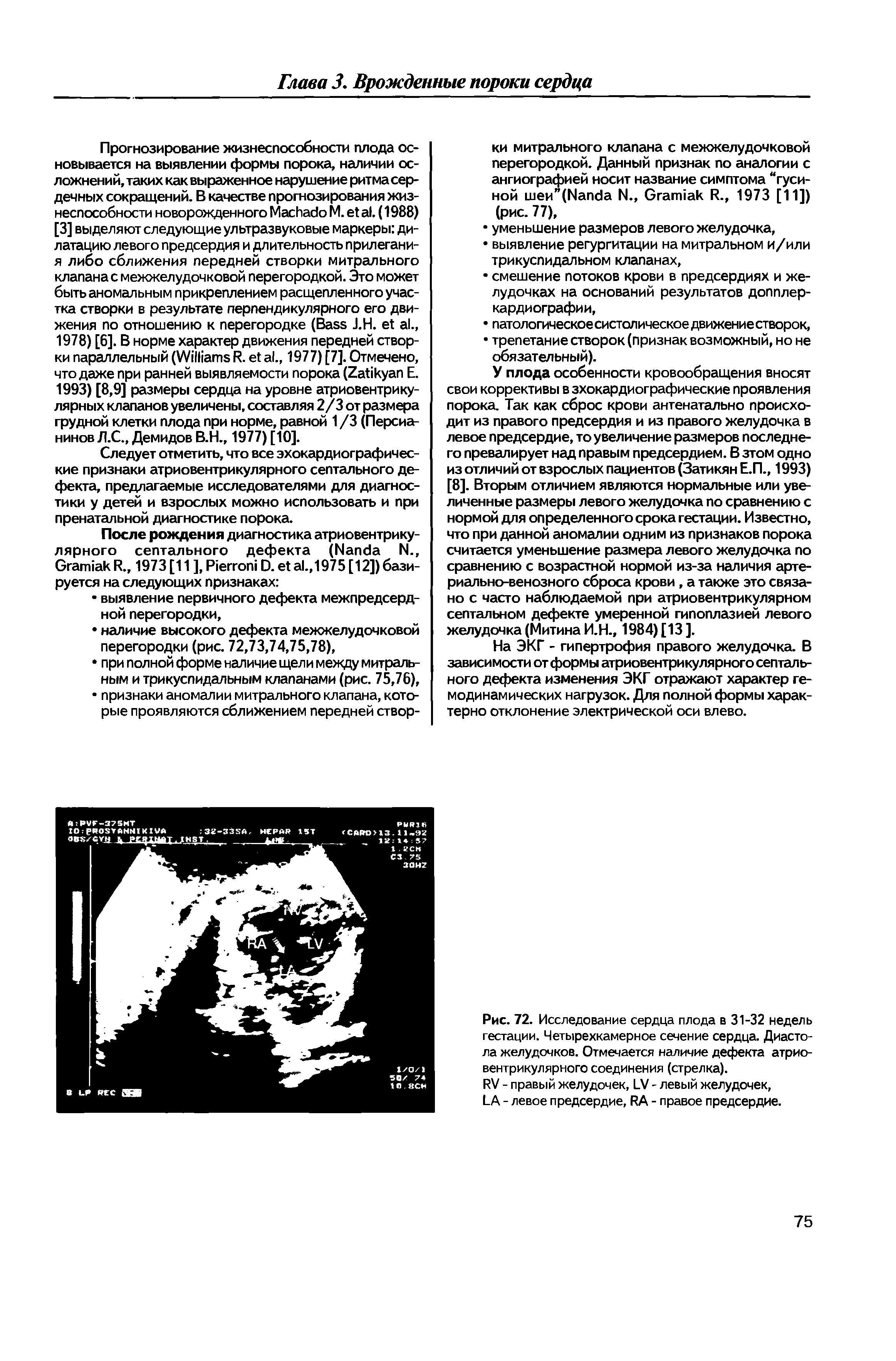 Рис. 72. Исследование сердца плода в 31-32 недель гестации. Четырехкамерное сечение сердца. Диастола желудочков. Отмечается наличие дефекта атриовентрикулярного соединения (стрелка).