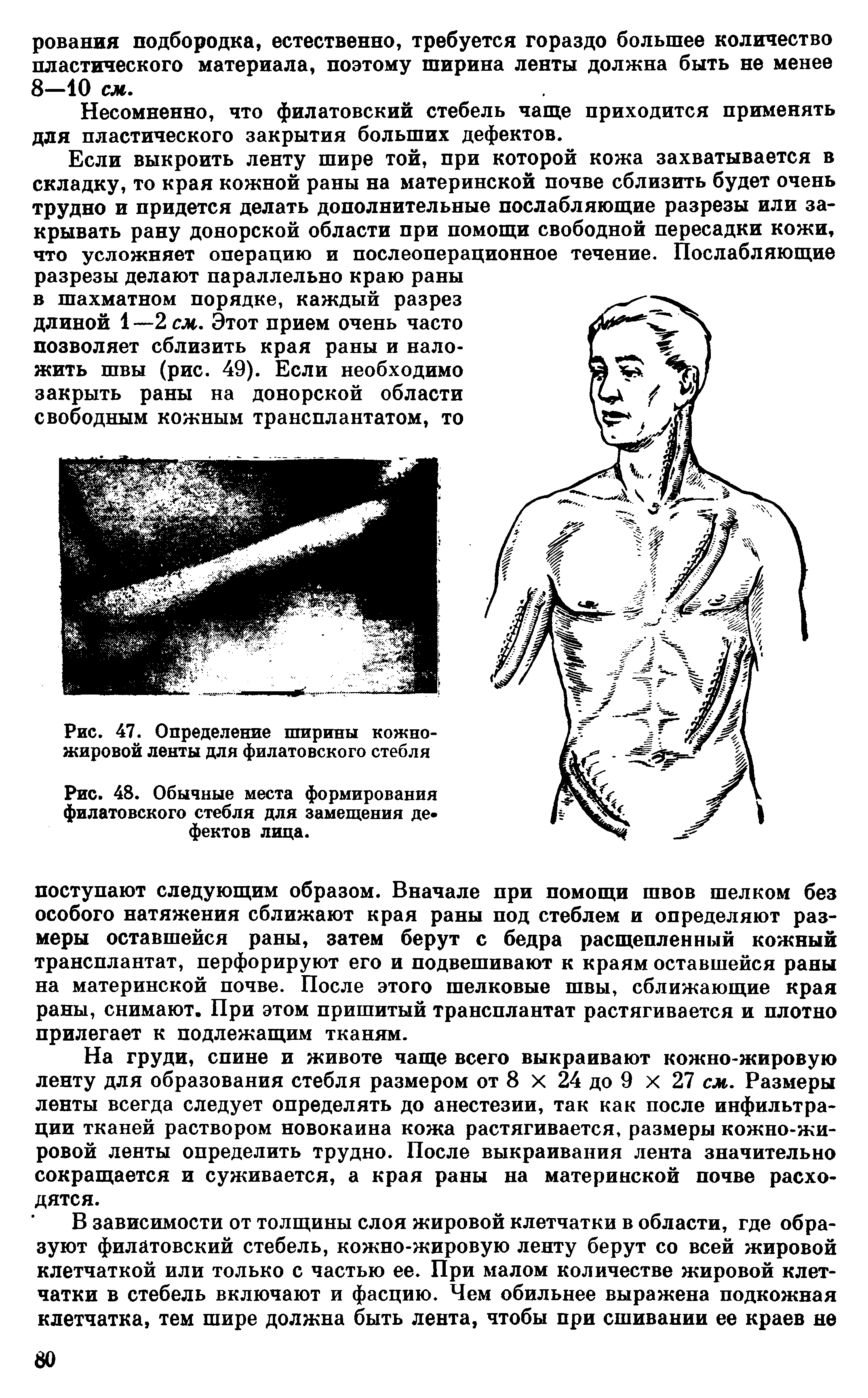 Рис. 48. Обычные места формирования филатовского стебля для замещения дефектов лица.