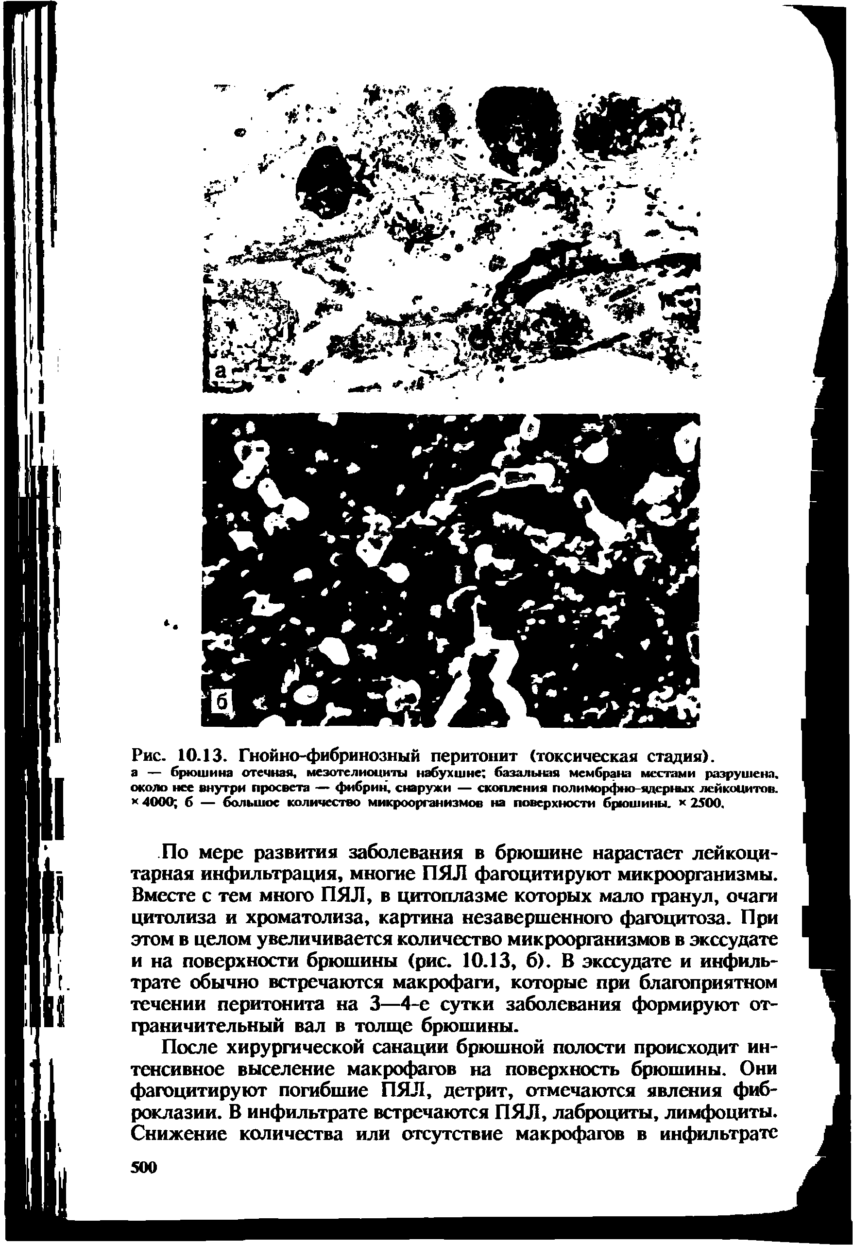 Рис. 10.13. Гнойно-фибринозный перитонит (токсическая стадия), а — брюшина отечная, мезотелиоциты набухшие базальная мембрана местами разрушена, около нее внутри просвета — фибрин, снаружи — скопления полиморфно-ядершх лейкоцитов. 4000 б — большое количество микроорганизмов на поверхности брюшины. х 2500.