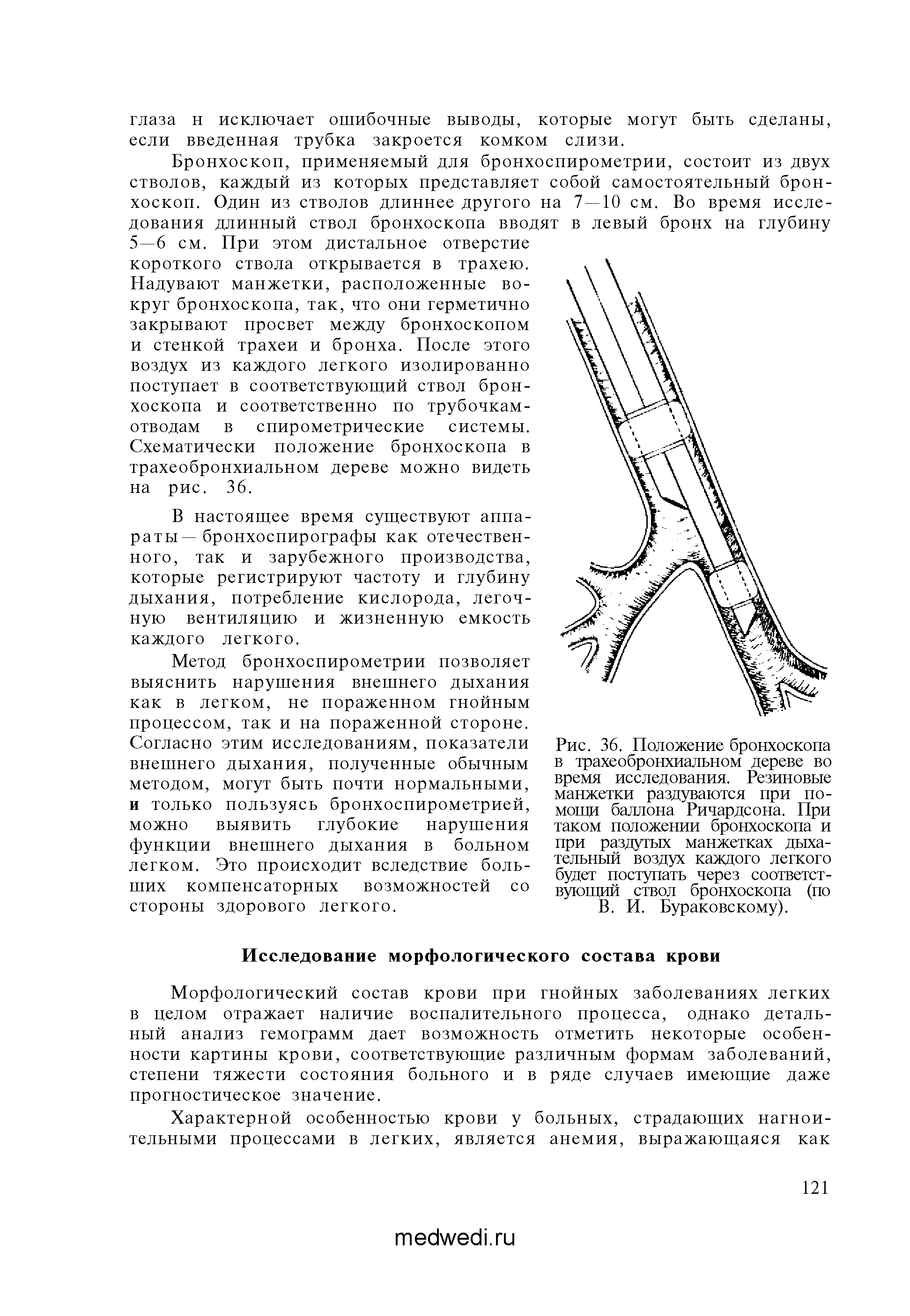 Рис. 36. Положение бронхоскопа в трахеобронхиальном дереве во время исследования. Резиновые манжетки раздуваются при помощи баллона Ричардсона. При таком положении бронхоскопа и при раздутых манжетках дыхательный воздух каждого легкого будет поступать через соответствующий ствол бронхоскопа (по В. И. Бураковскому).