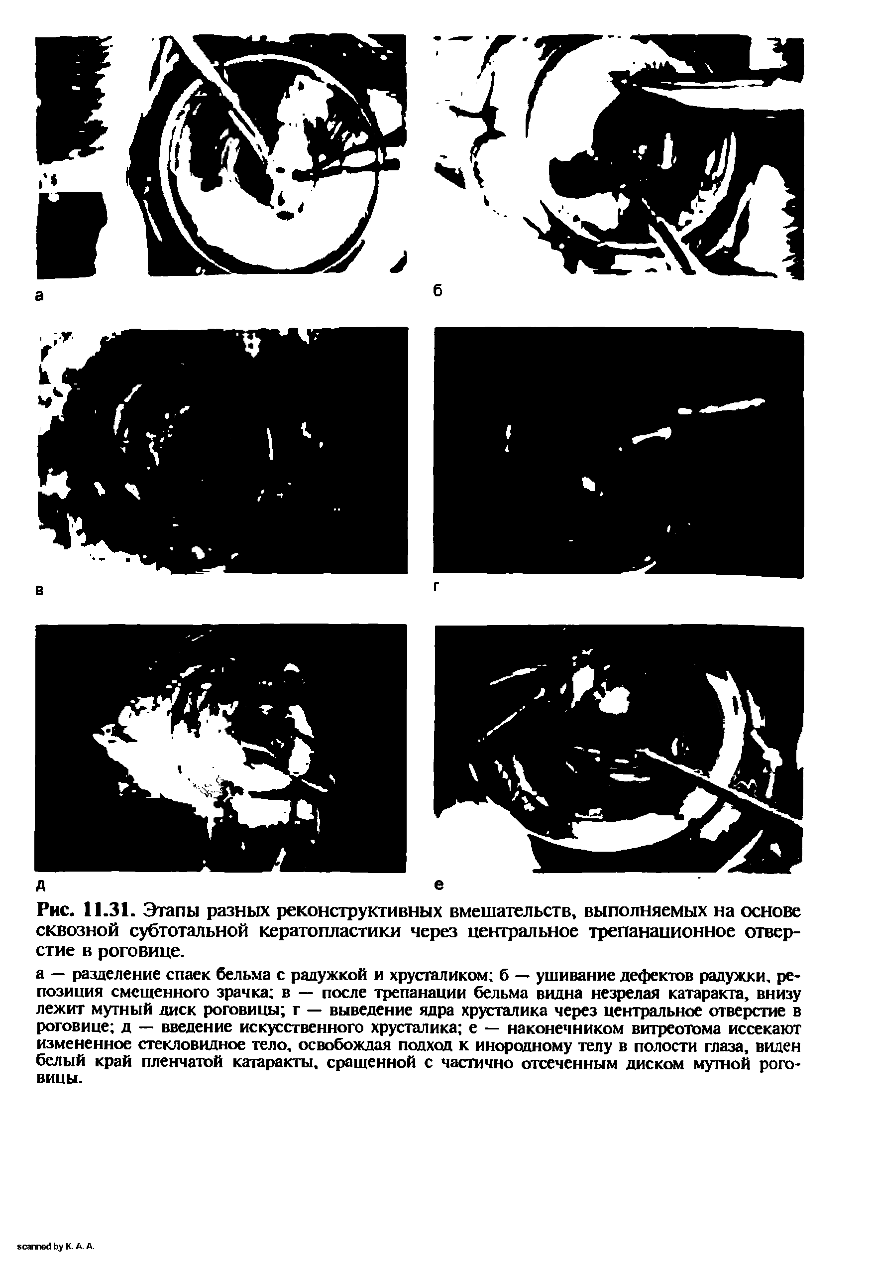 Рис. 11.31. Этапы разных реконструктивных вмешательств, выполняемых на основе сквозной субтотальной кератопластики через центральное трепанационное отверстие в роговице.