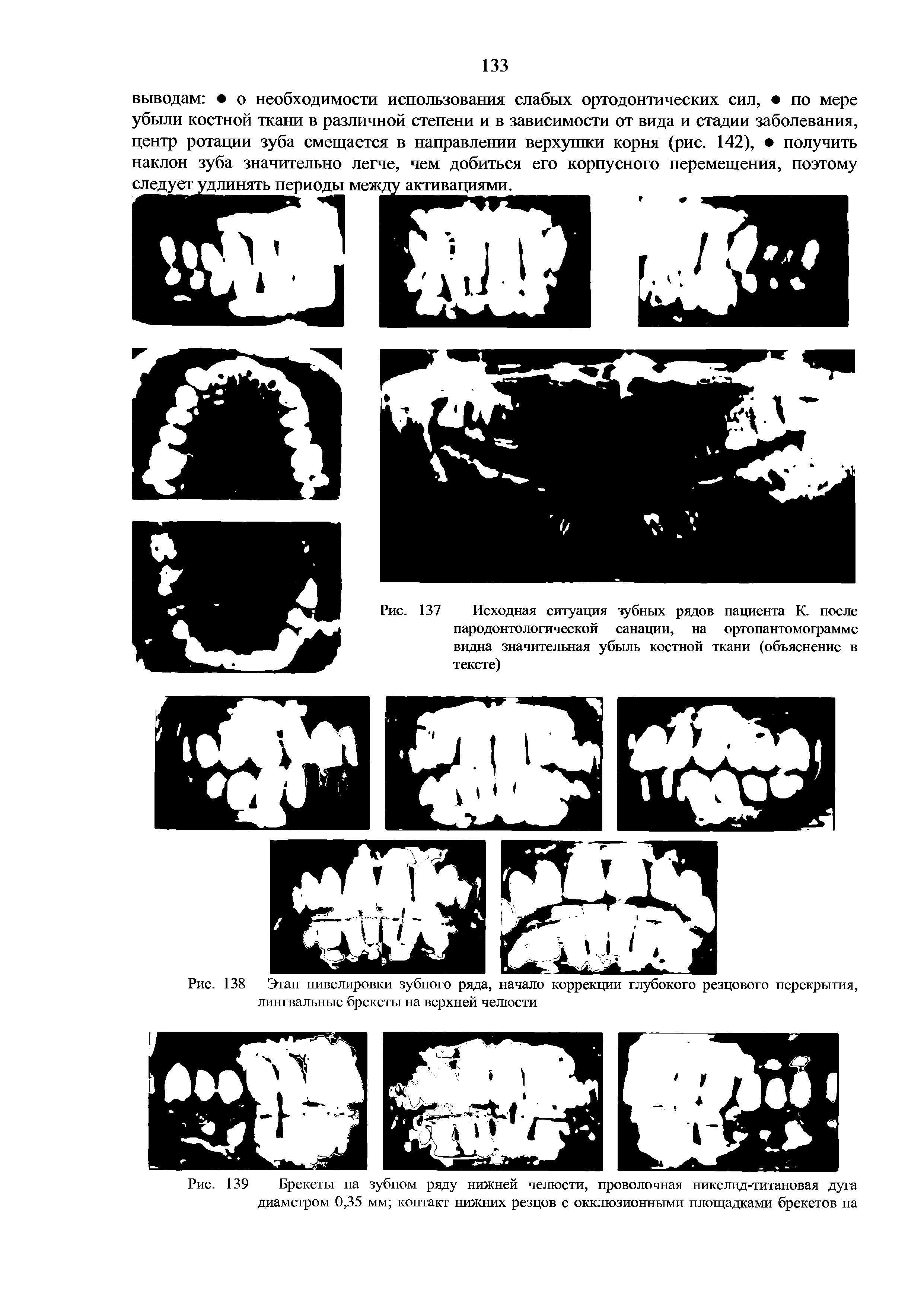 Рис. 139 Брекеты на зубном ряду нижней челюсти, проволочная никелид-титановая дуга диаметром 0,35 мм контакт нижних резцов с окклюзионными площадками брекетов на...