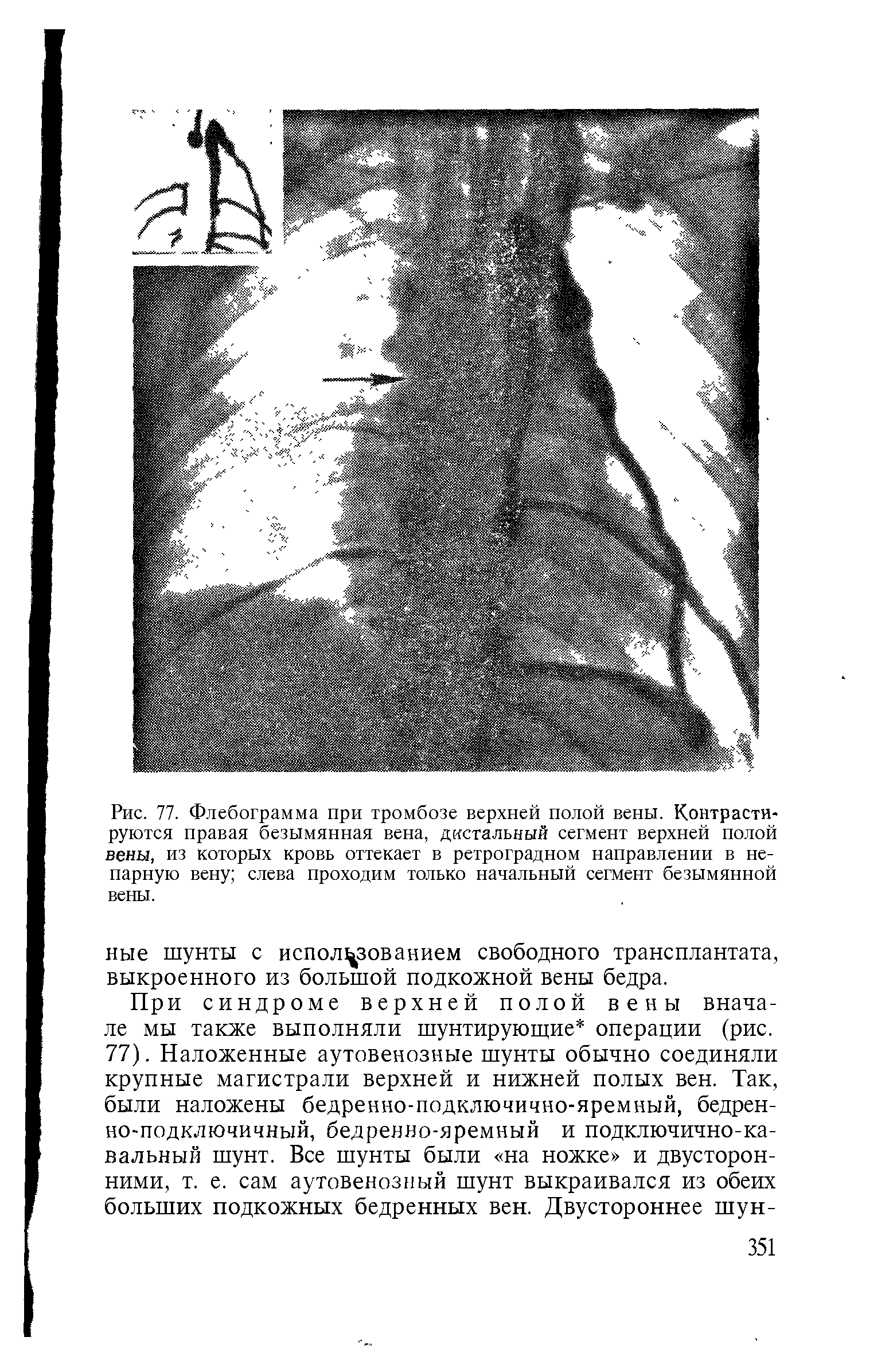 Рис. 77. Флебограмма при тромбозе верхней полой вены. Контрастируются правая безымянная вена, дистальный сегмент верхней полой вены, из которых кровь оттекает в ретроградном направлении в непарную вену слева проходим только начальный сегмент безымянной вены.