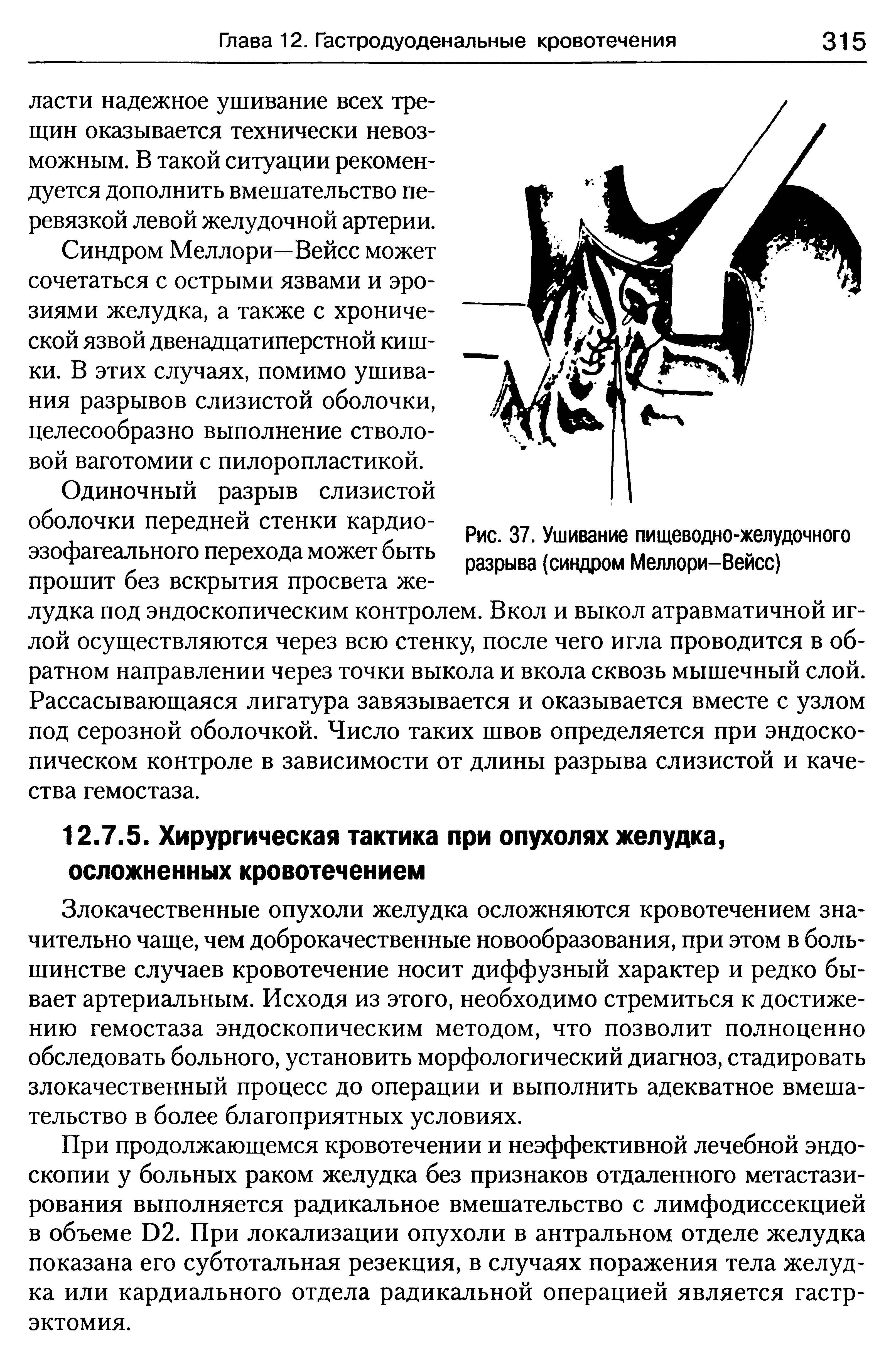 Рис. 37. Ушивание пищеводно-желудочного разрыва (синдром Меллори-Вейсс)...