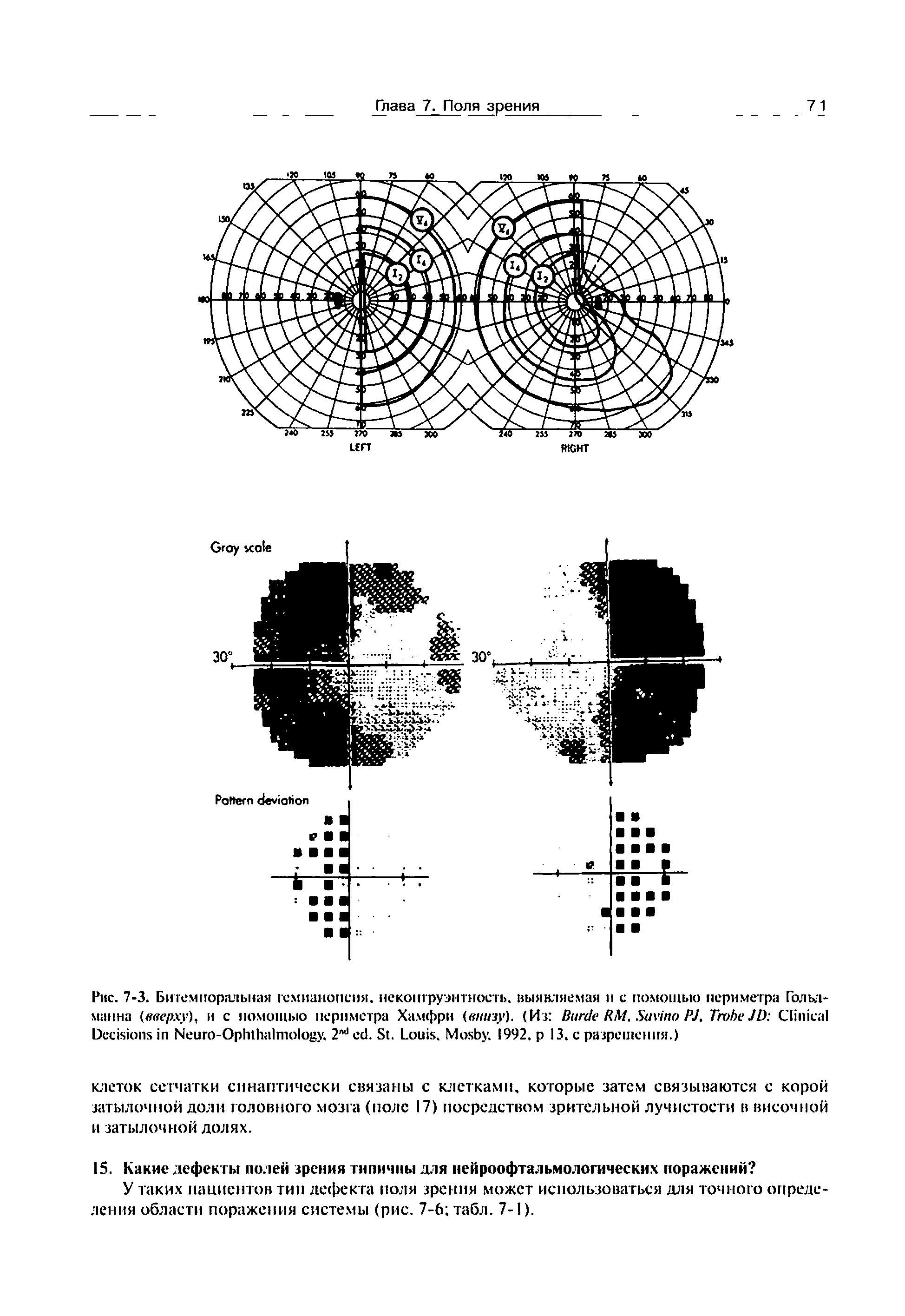 Рис. 7-3. Битемпоральная гсмианопсня. неко1Пруэнтность. выявляемая и с помощью периметра Гольд-манна (вверху). и с помощью периметра Хамфри (внизу). (Из B RM, S PJ, T JD C D N -O . 2 . S . L . M . 1992, I3. с разрешения.)...