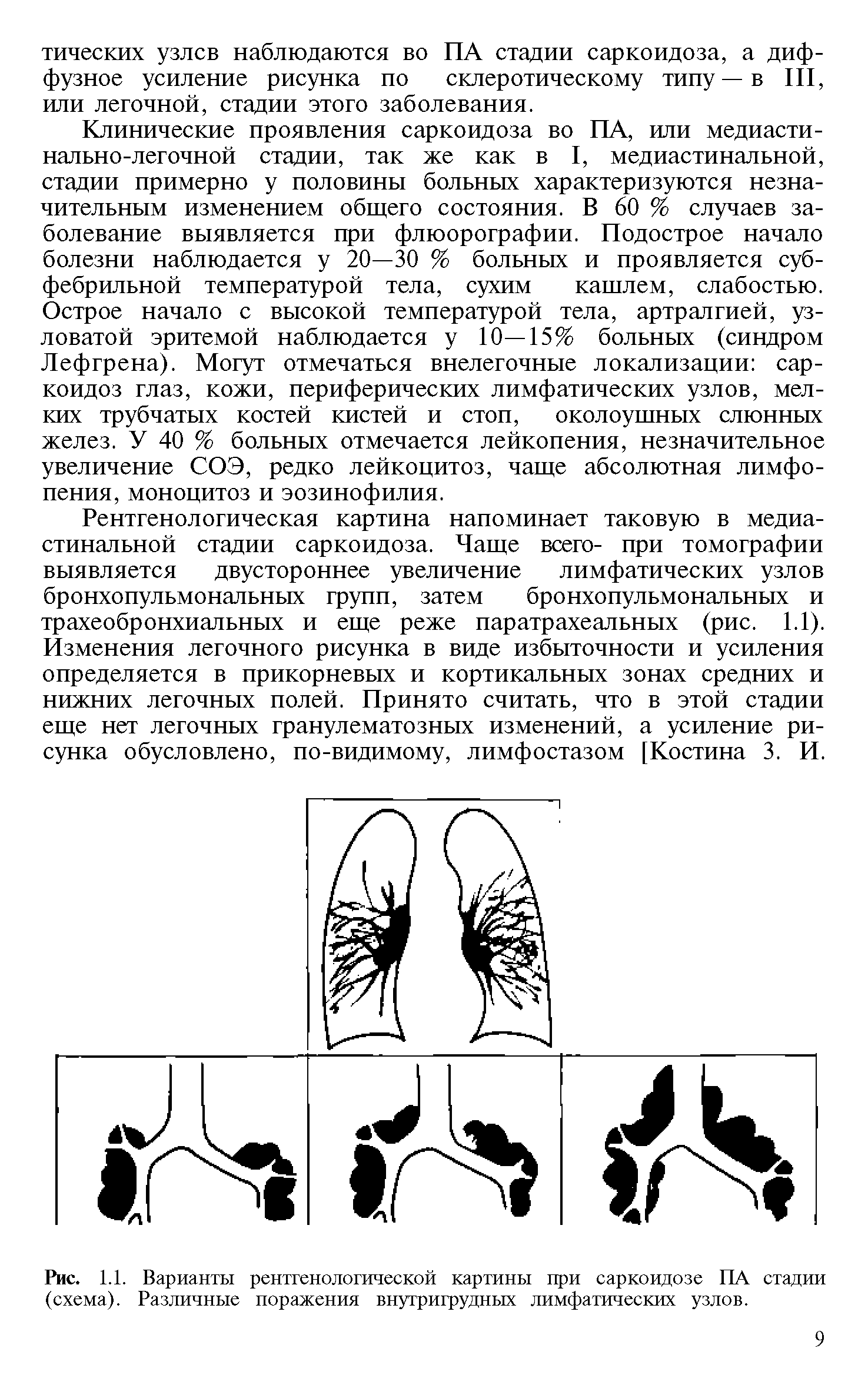 Рис. 1.1. Варианты рентгенологической картины при саркоидозе ПА стадии (схема). Различные поражения внутригрудных лимфатических узлов.