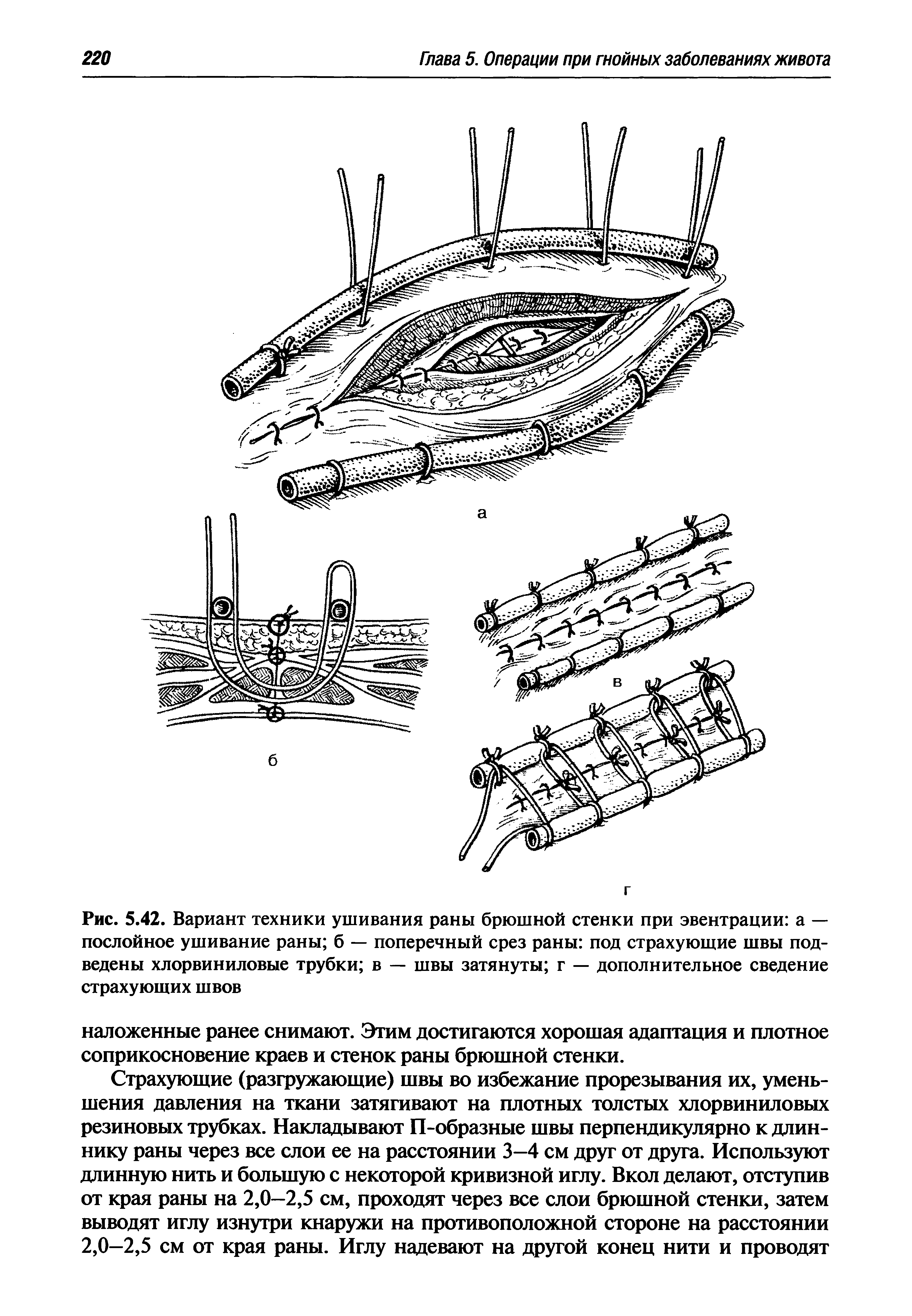 Рис. 5.42. Вариант техники ушивания раны брюшной стенки при эвентрации а — послойное ушивание раны б — поперечный срез раны под страхующие швы подведены хлорвиниловые трубки в — швы затянуты г — дополнительное сведение страхующих швов...