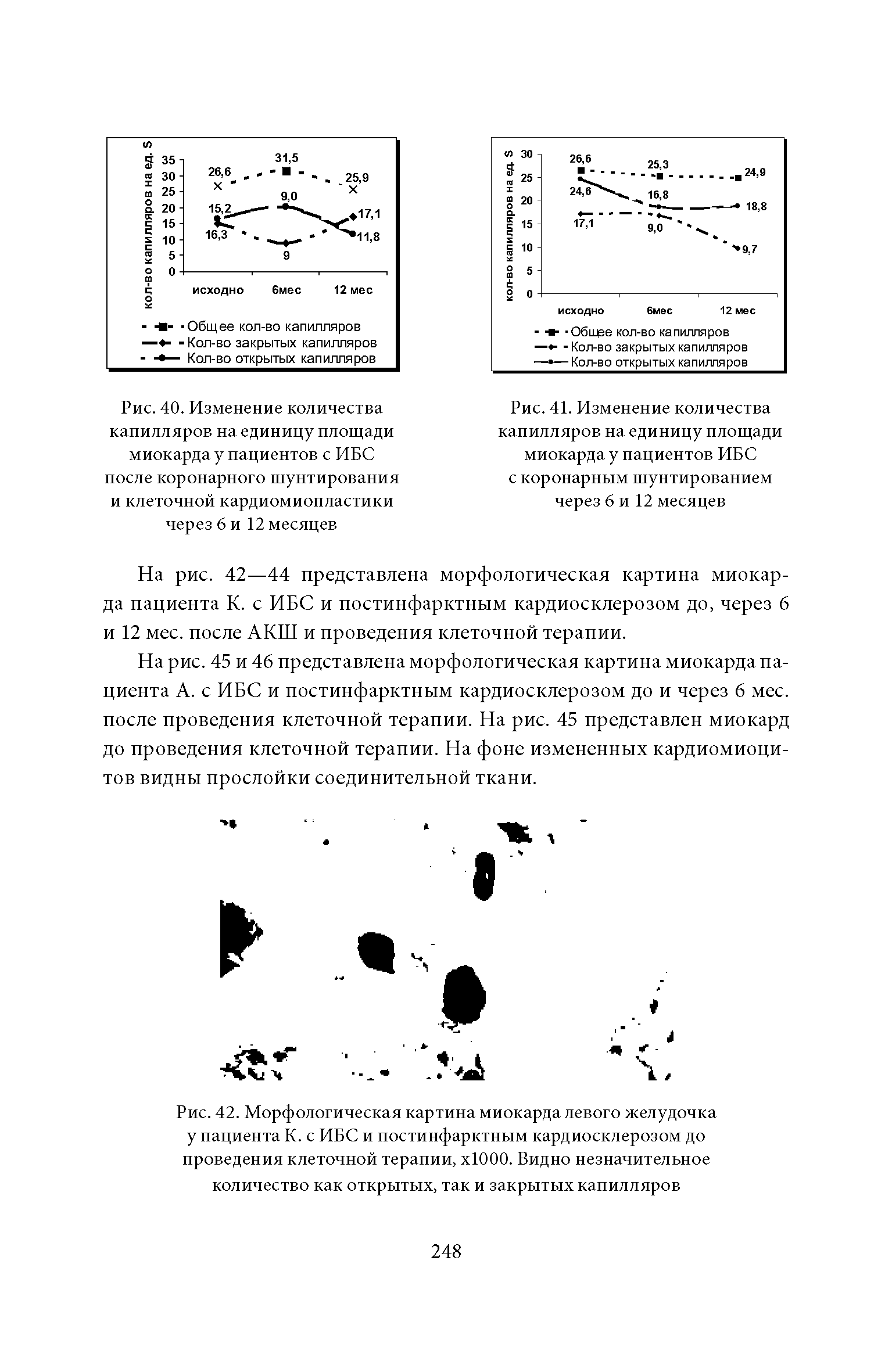 Рис. 40. Изменение количества капилляров на единицу площади миокарда у пациентов с ИБС после коронарного шунтирования и клеточной кардиомиопластики через 6 и 12 месяцев...