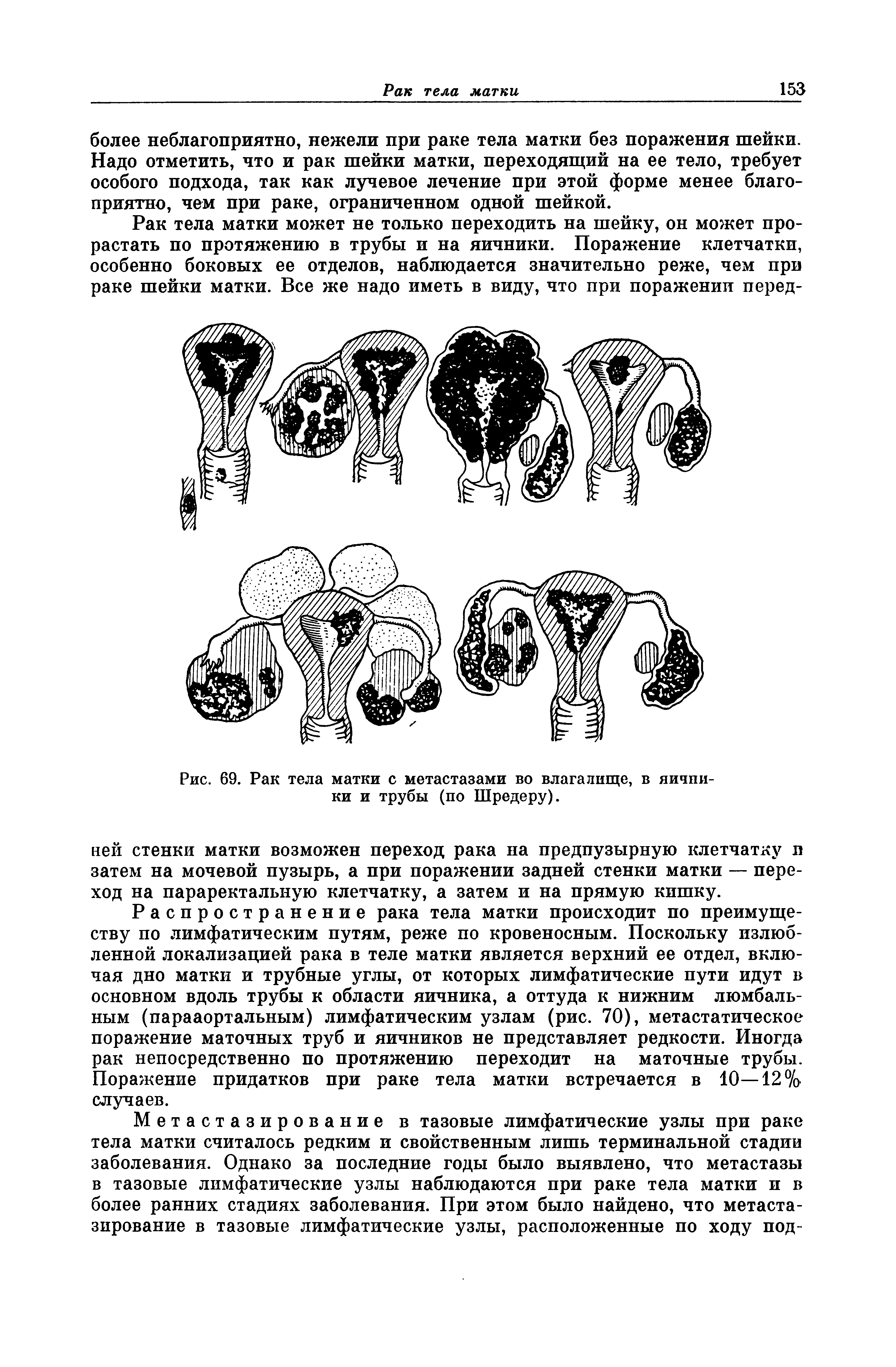 Рис. 69. Рак тела матки с метастазами во влагалище, в яичпи-ки и трубы (по Шредеру).