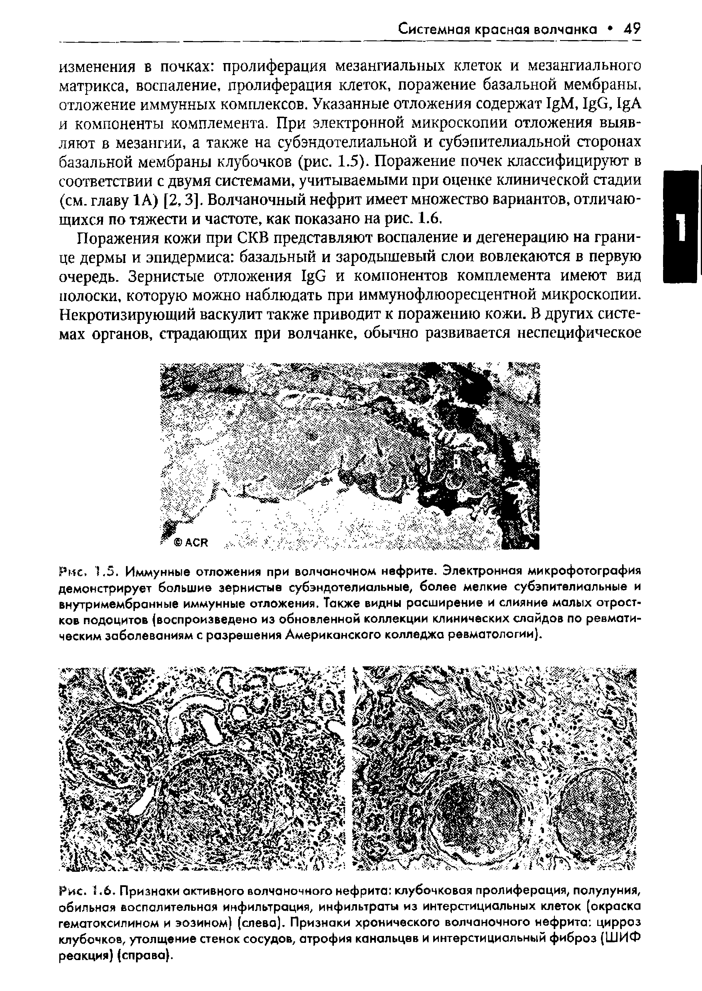 Рис. 1,6. Признаки активного волчаночного нефрита клубочковая пролиферация, полулуния, обильная воспалительная инфильтрация, инфильтраты из интерстициальных клеток (окраска гематоксилином и эозином) (слева). Признаки хронического волчаночного нефрита цирроз клубочков, утолщение стенок сосудов, атрофия канальцев и интерстициальный фиброз (ШИФ реакция) (справа).