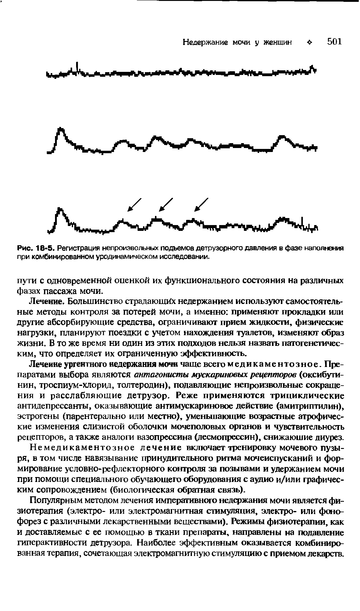 Рис. 18 5. Регистрация непроизвольных подъемов детрузорного давления в фазе наполнения при комбинированном уродинамическом исследовании.