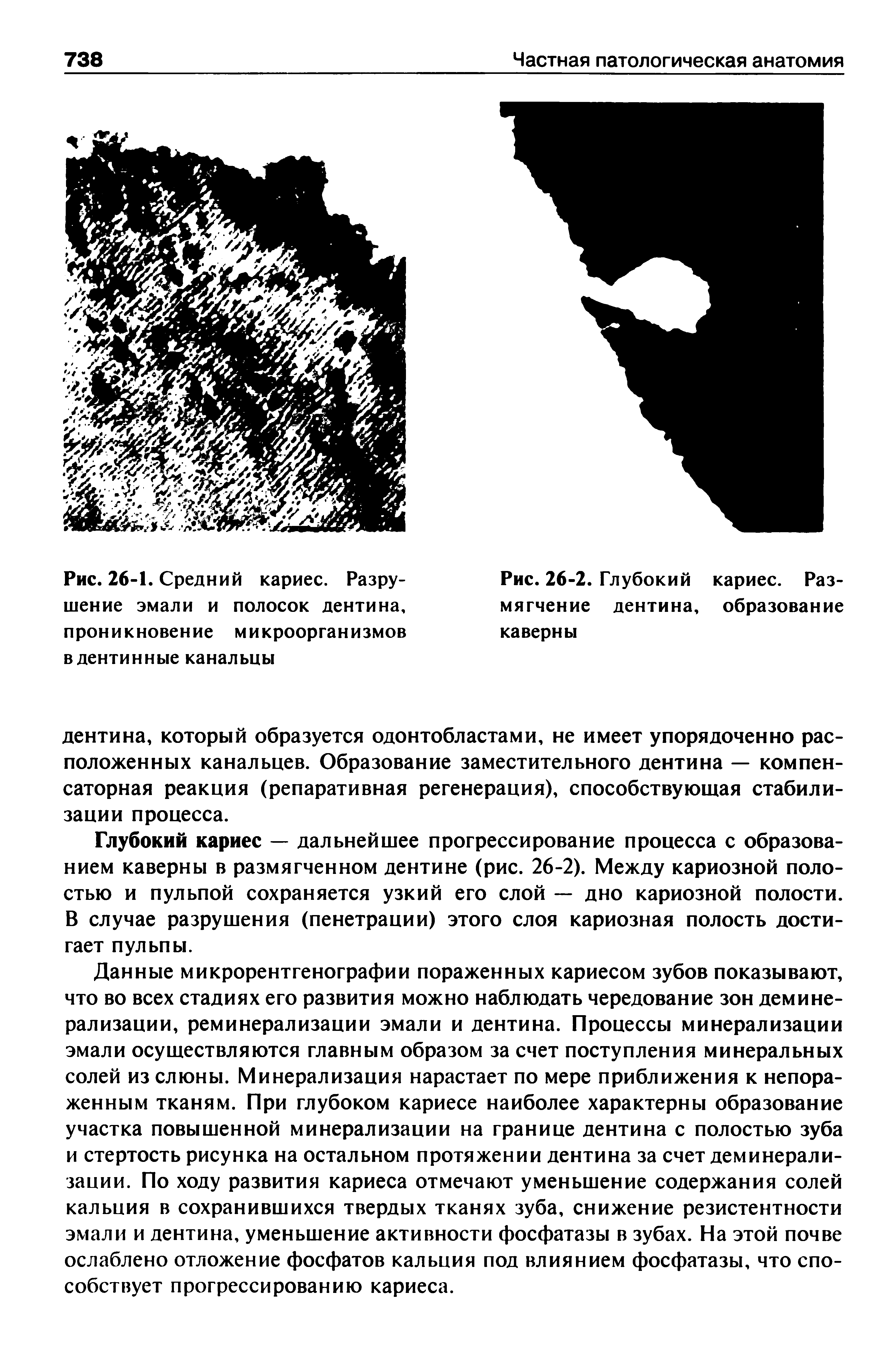 Рис. 26-2. Глубокий кариес. Размягчение дентина, образование каверны...