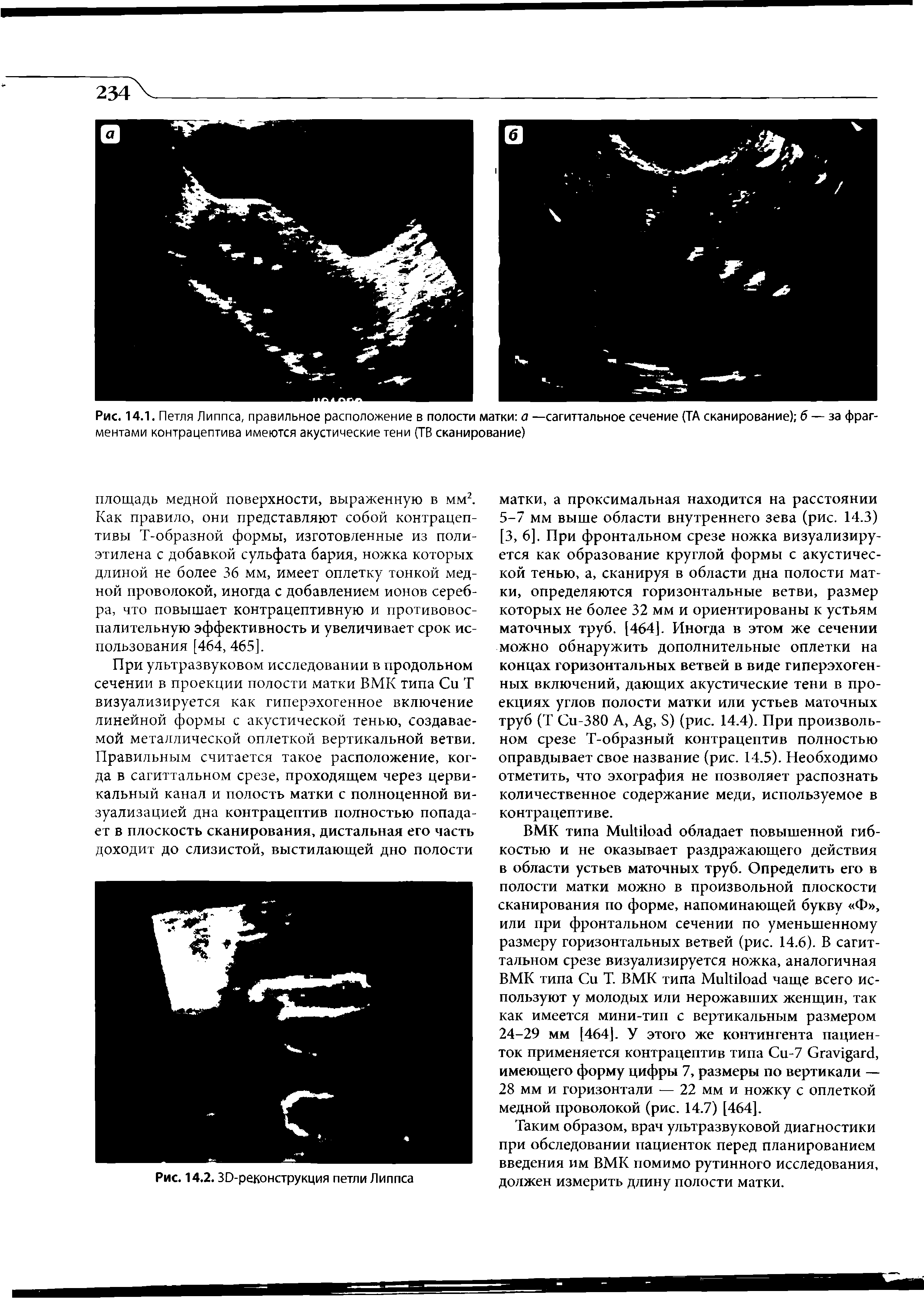 Рис. 14.1. Петля Липпса, правильное расположение в полости матки а —сагиттальное сечение (ТА сканирование) б — за фрагментами контрацептива имеются акустические тени (ТВ сканирование)...