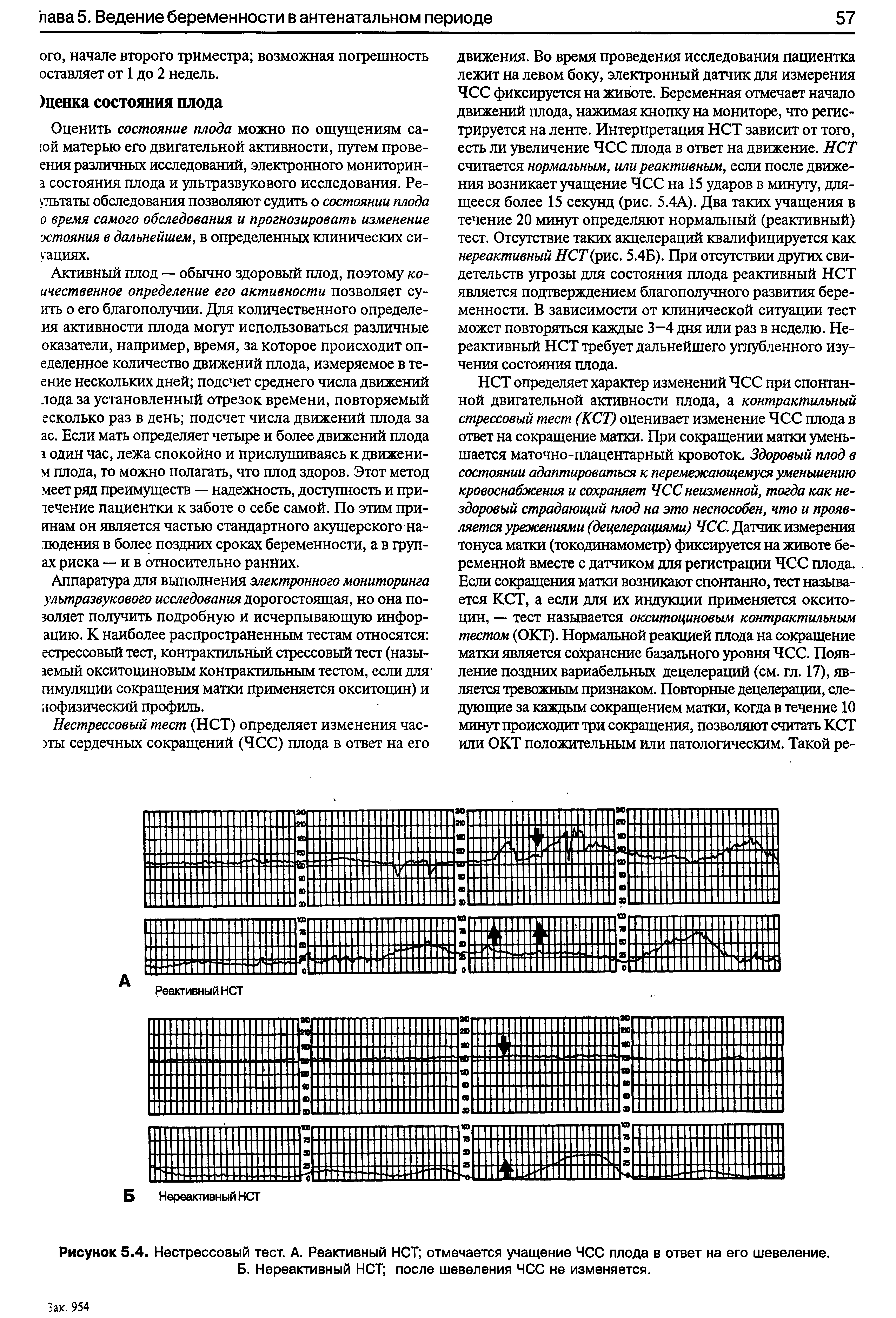 Рисунок 5.4. Нестрессовый тест. А. Реактивный НСТ отмечается учащение ЧСС плода в ответ на его шевеление. Б. Нереактивный НСТ после шевеления ЧСС не изменяется.