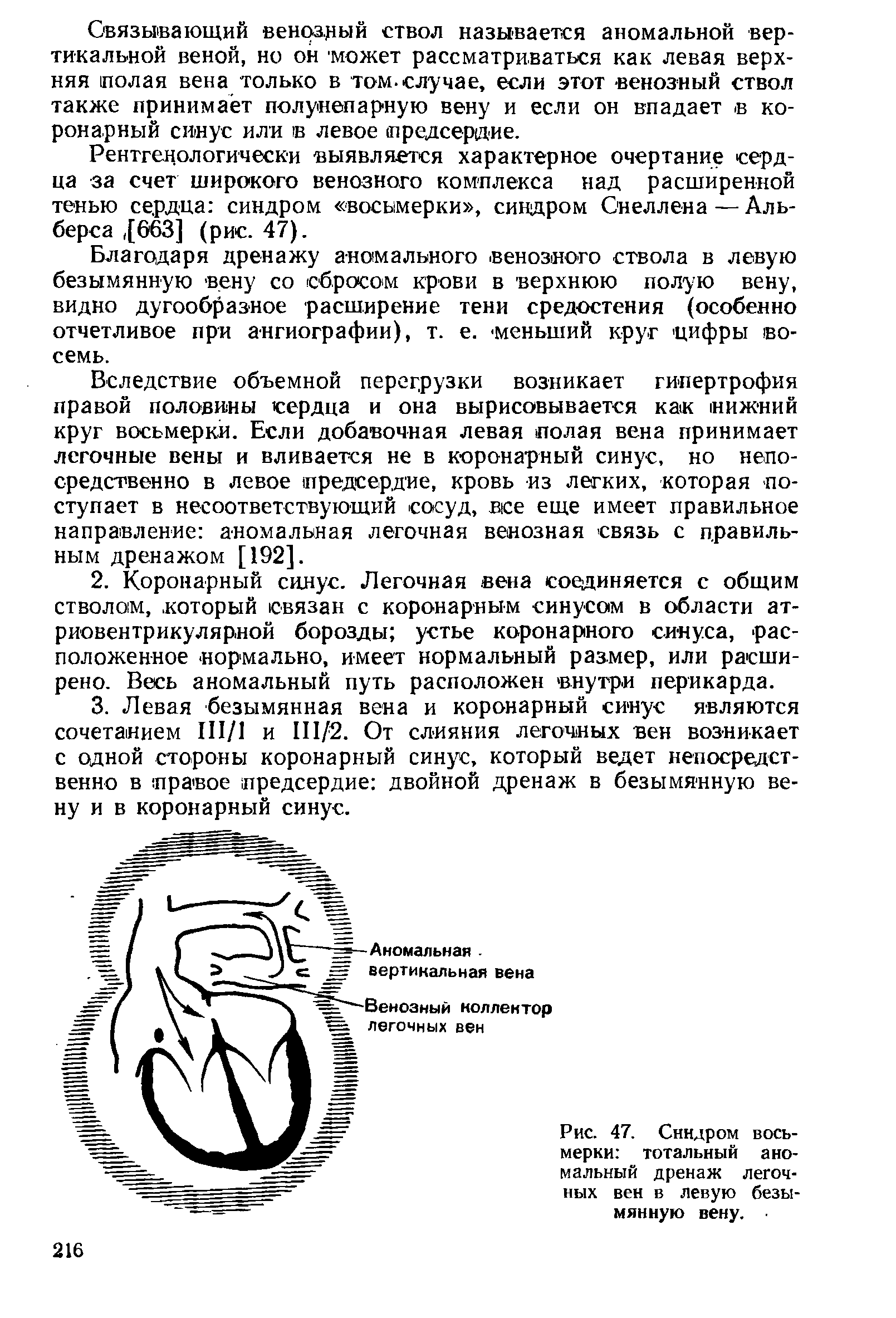 Рис. 47. Синдром восьмерки тотальный аномальный дренаж легочных вен в левую безымянную вену.