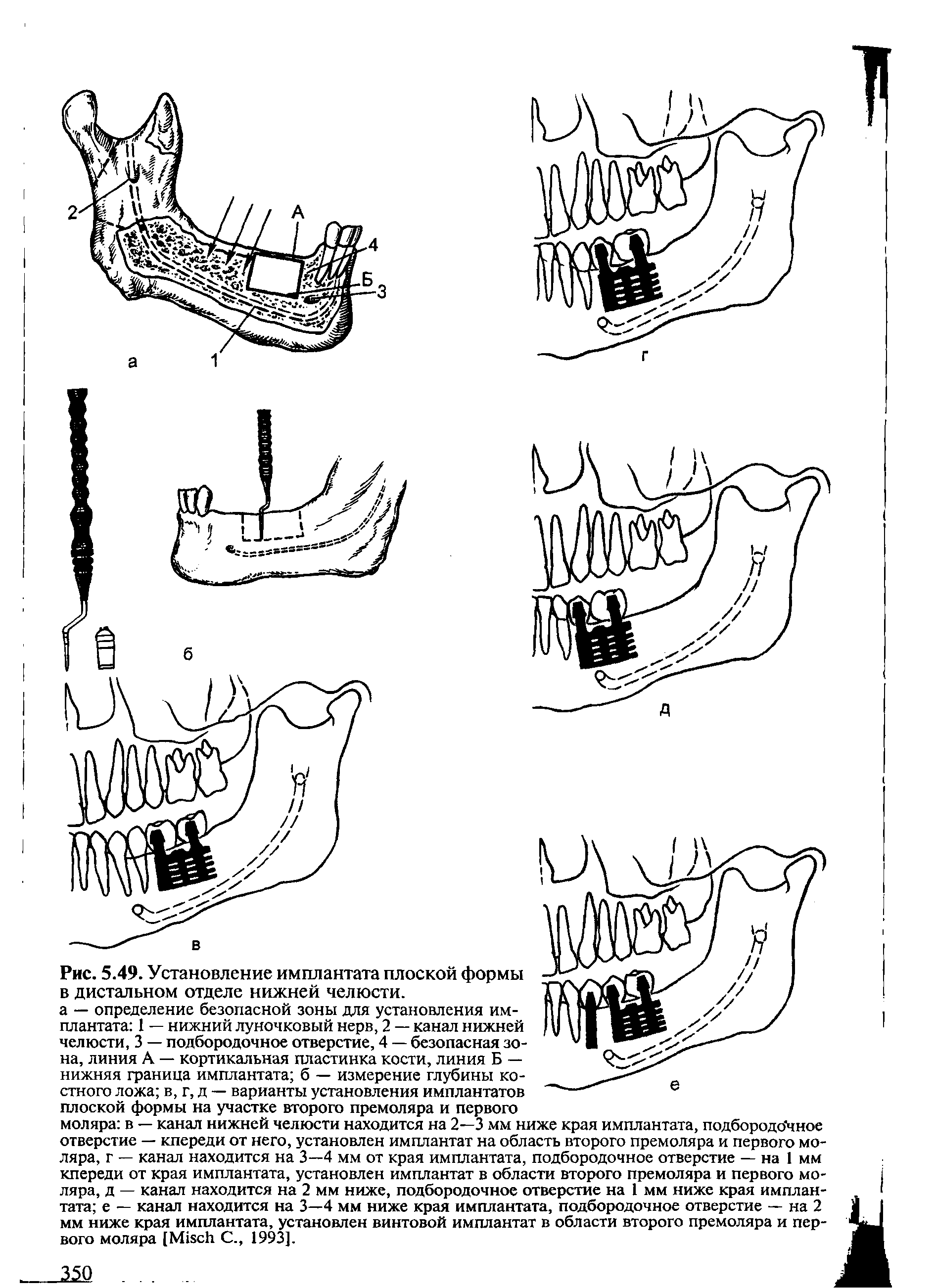 Рис. 5.49. Установление имплантата плоской формы в дистальном отделе нижней челюсти.
