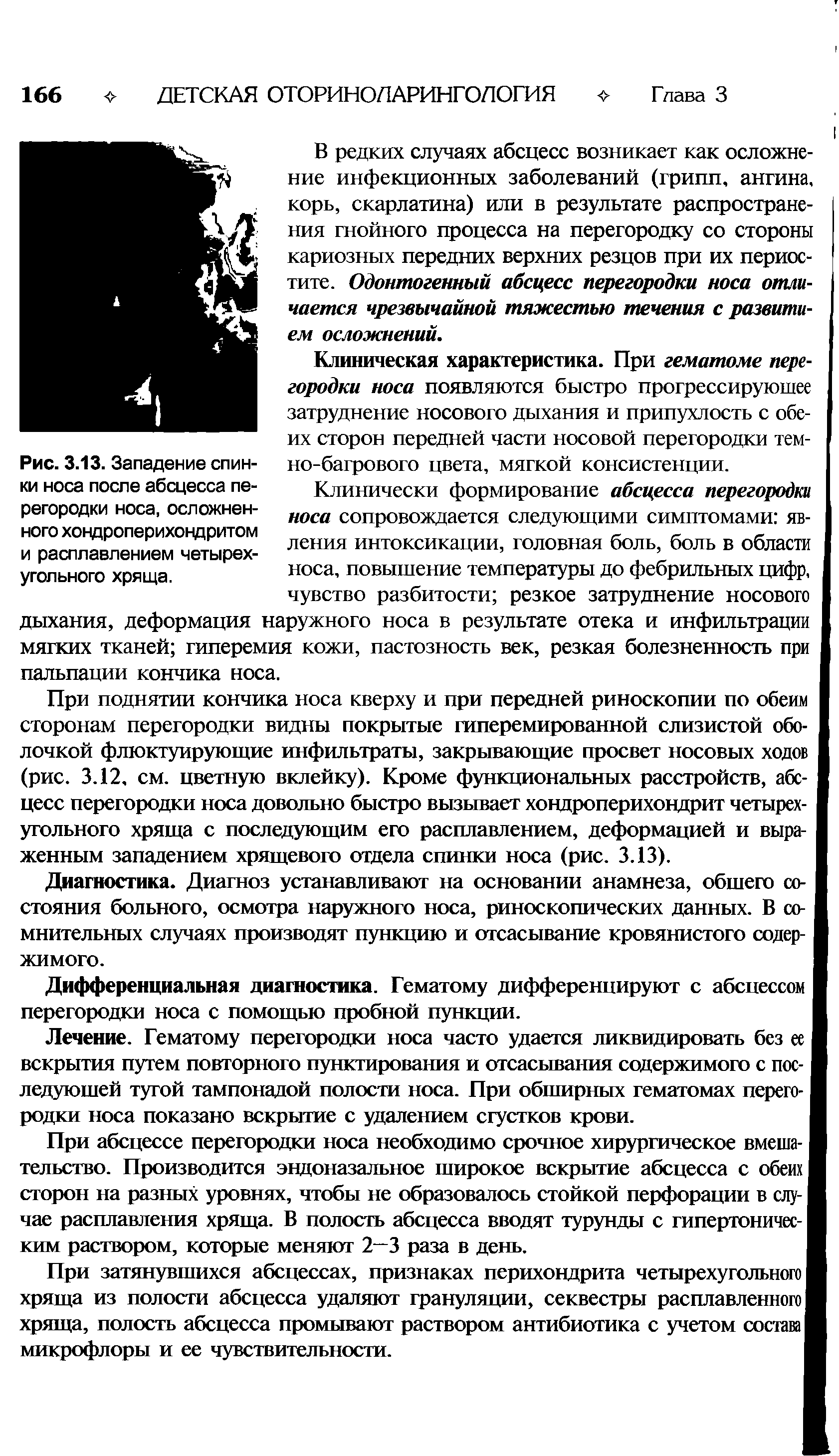 Рис. 3.13. Западение спинки носа после абсцесса перегородки носа, осложненного хондроперихондритом и расплавлением четырехугольного хряща.