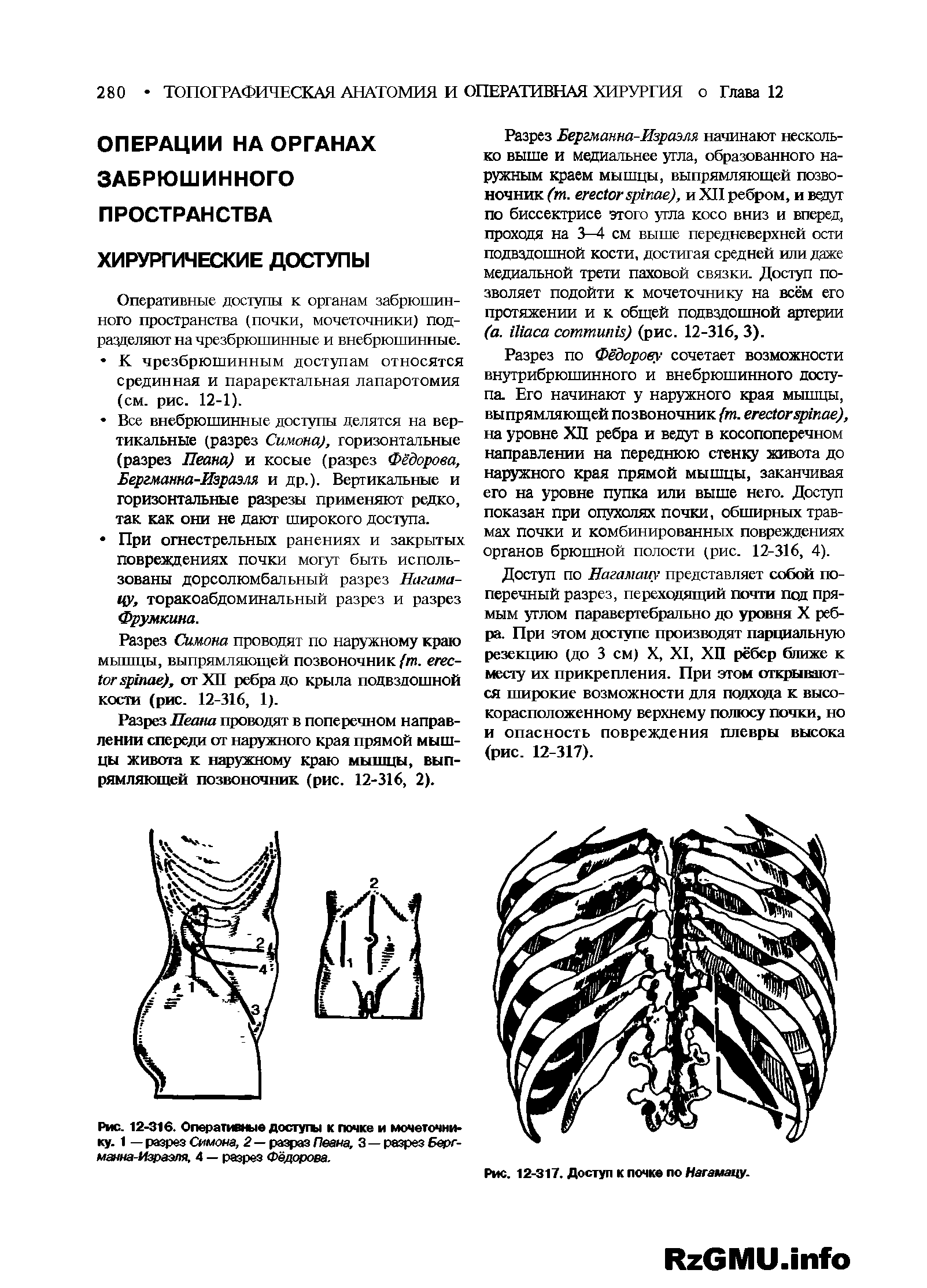 Рис. 12-316. Оперативные доступы к почке и мочеточнику. 1 — разрез Симона, 2 — разрез Пеана, 3 — разрез Бергманна-Израэля, 4 — разрез Фёдорова.