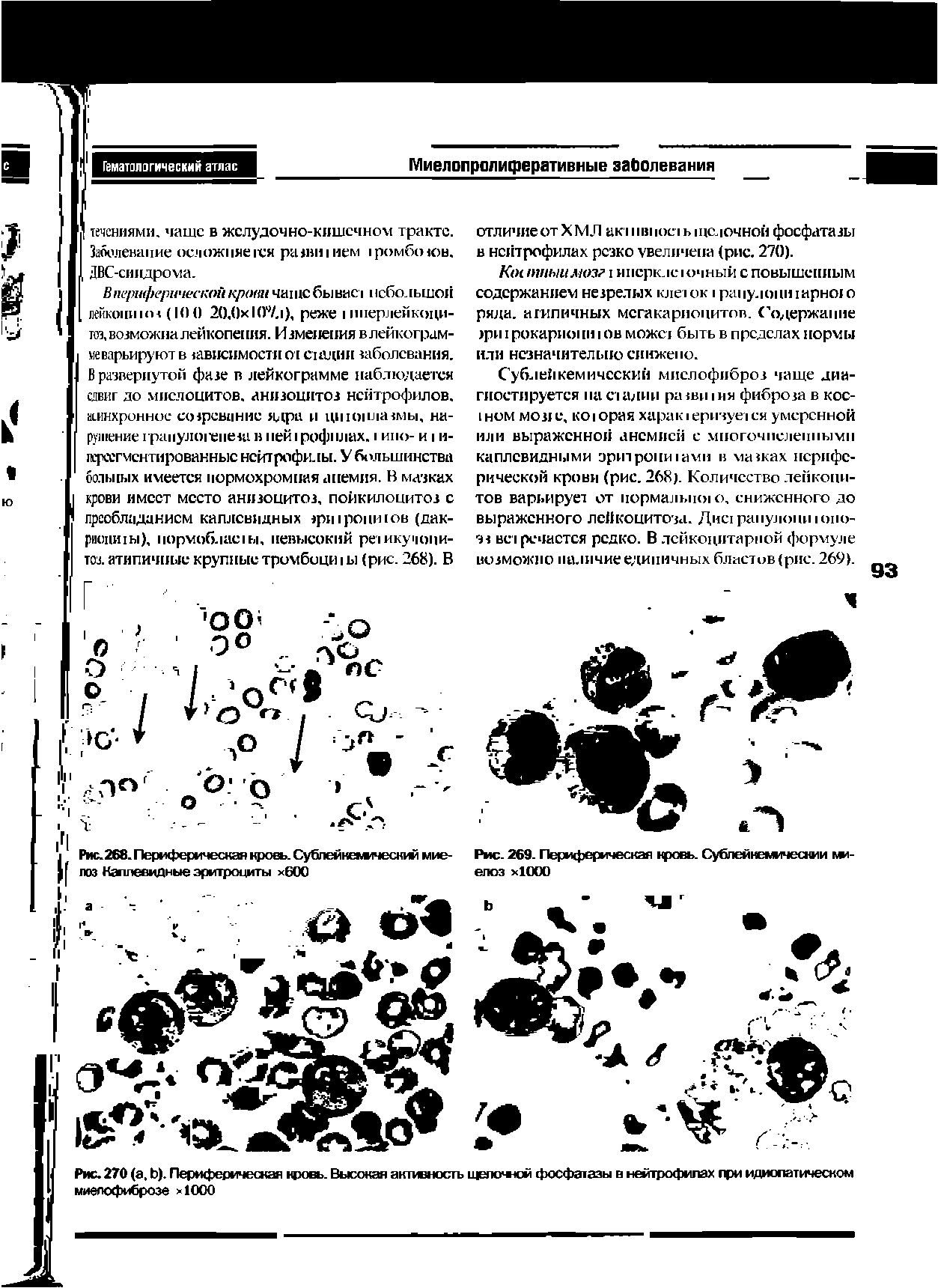 Рис.268. Периферическая кровь. Сублеинемзческий миелоз Каплевидные эритроциты хбОО...