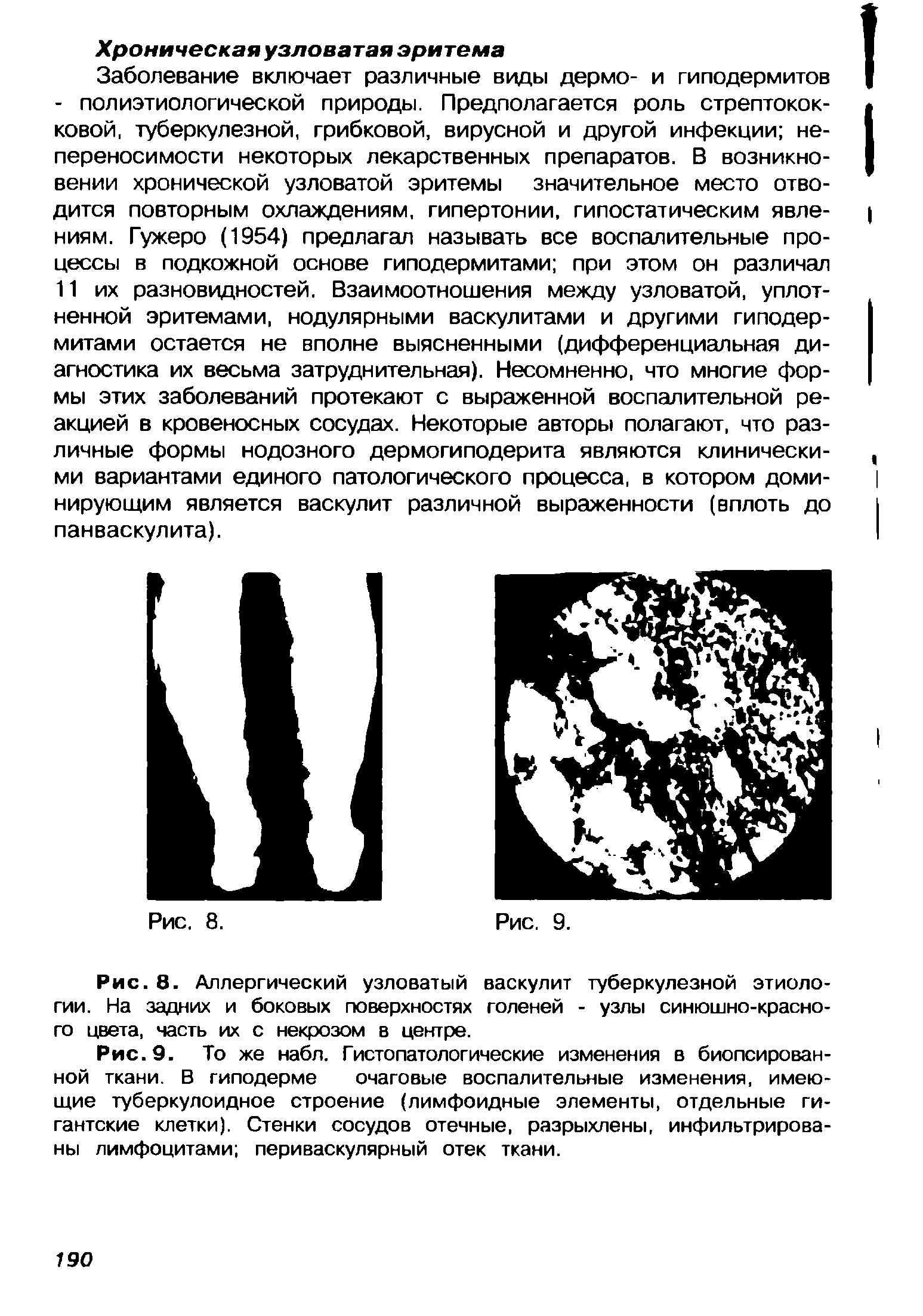 Рис. 9. То же набл. Гистопатологические изменения в биопсирован-ной ткани. В гиподерме очаговые воспалительные изменения, имеющие туберкулоидное строение (лимфоидные элементы, отдельные гигантские клетки). Стенки сосудов отечные, разрыхлены, инфильтрированы лимфоцитами периваскулярный отек ткани.