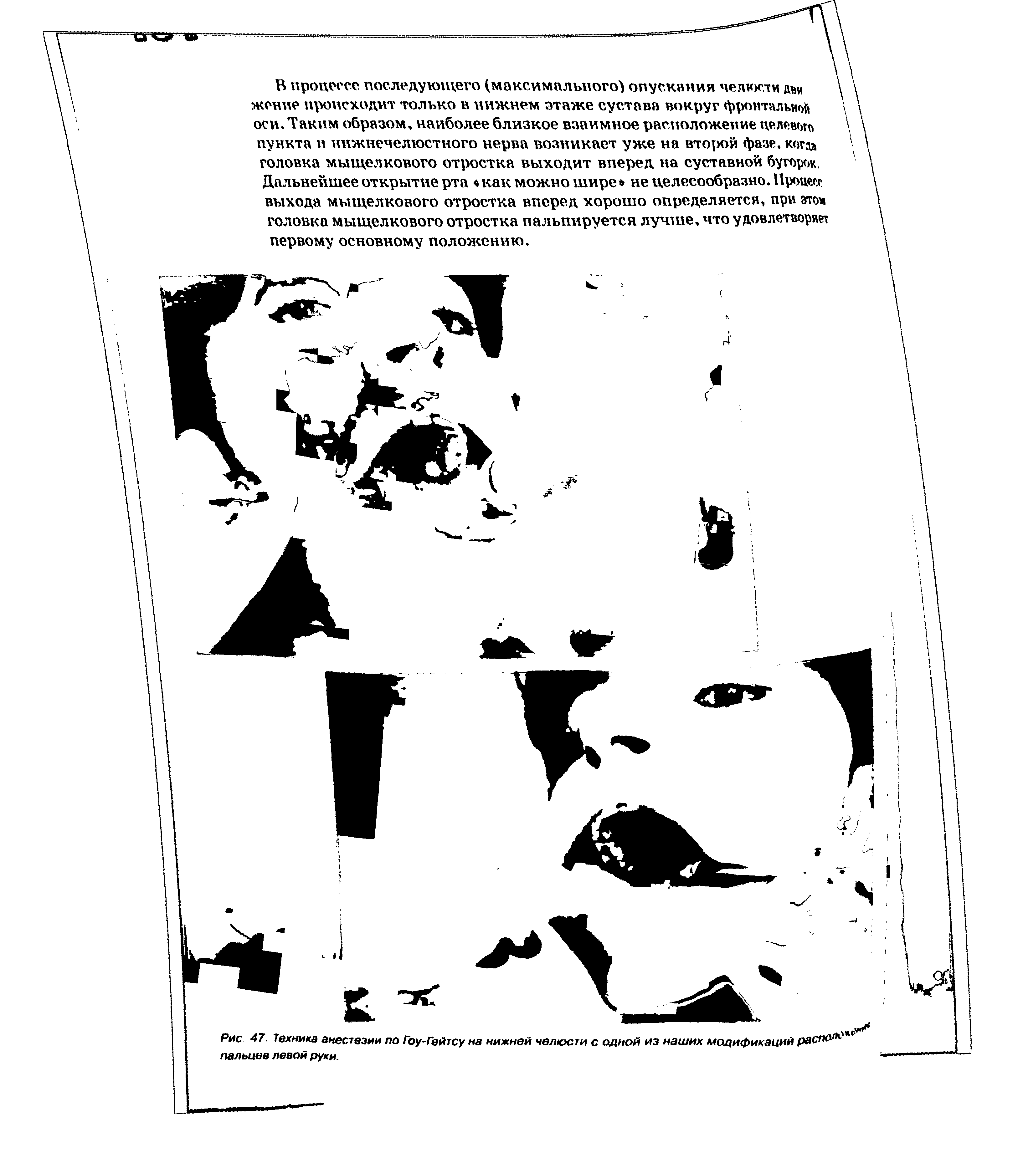 Рис. 47. Техника анестезии по Гоу-Гейтсу на нижней челюсти с одной из наших модификаций распой пальцев левой руки.