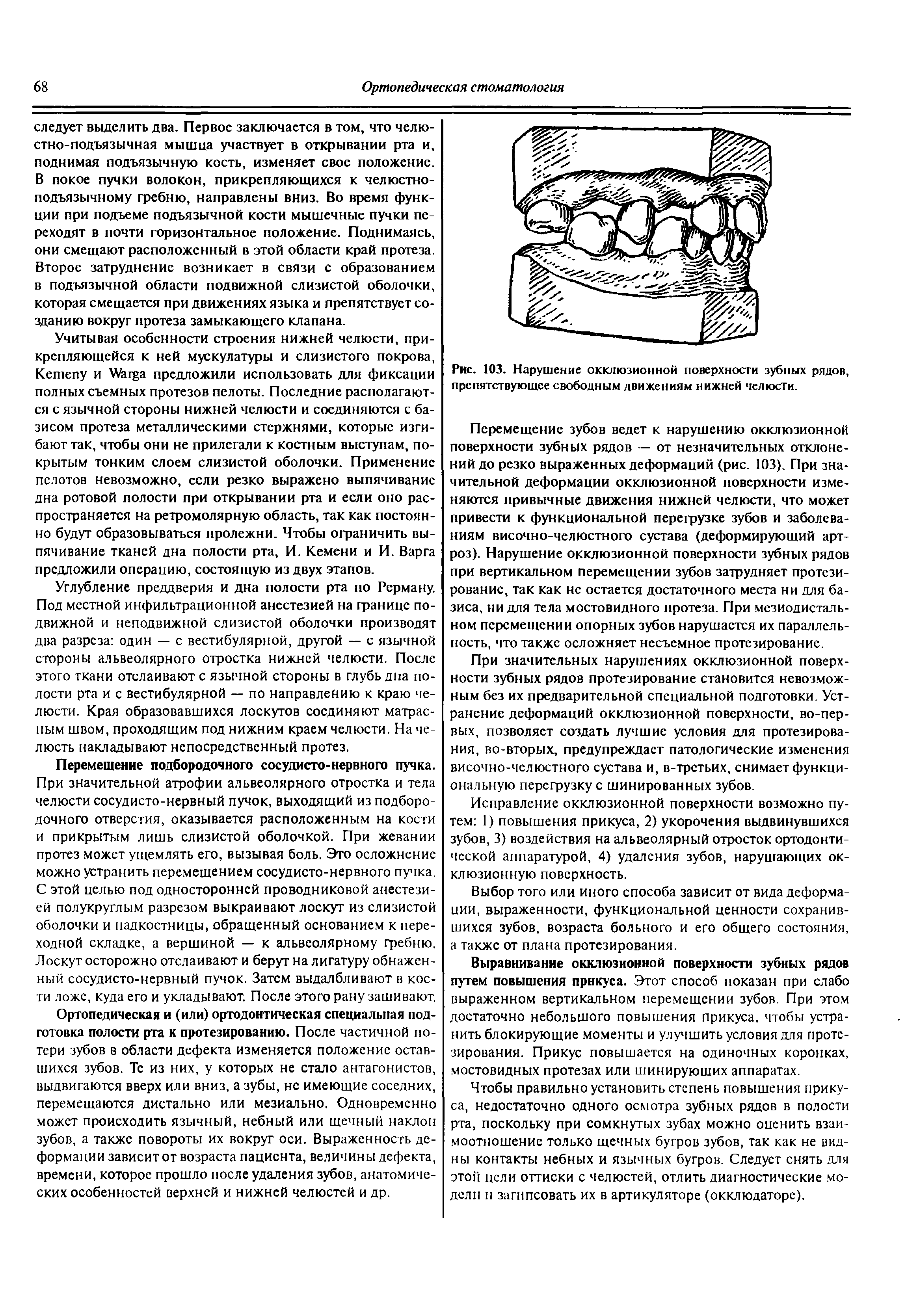 Рис. 103. Нарушение окклюзионной поверхности зубных рядов, препятствующее свободным движениям нижней челюсти.