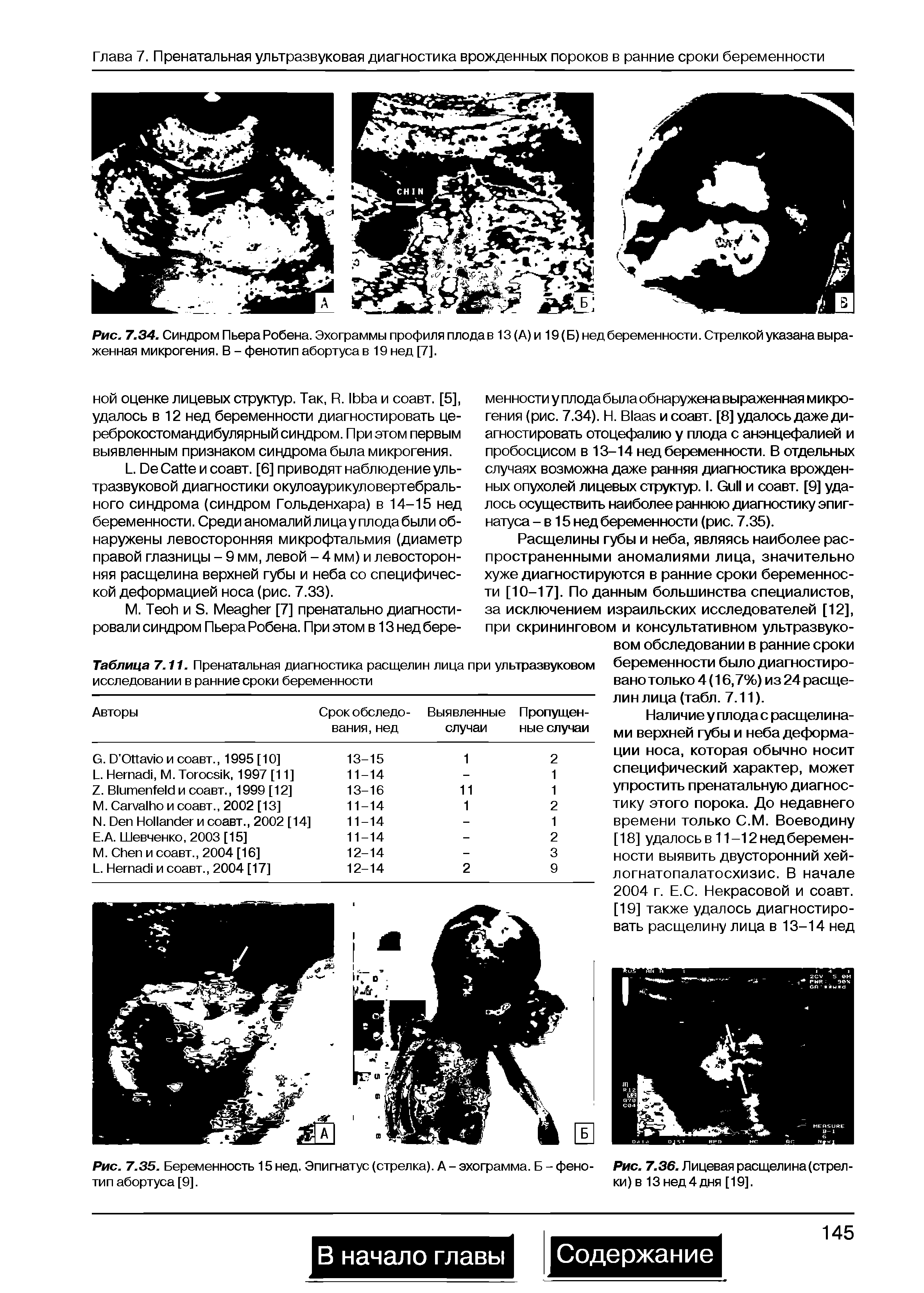 Рис. 7.35. Беременность 15 нед. Эпигнатус (стрелка). А - эхограмма. Б - фенотип абортуса [9].