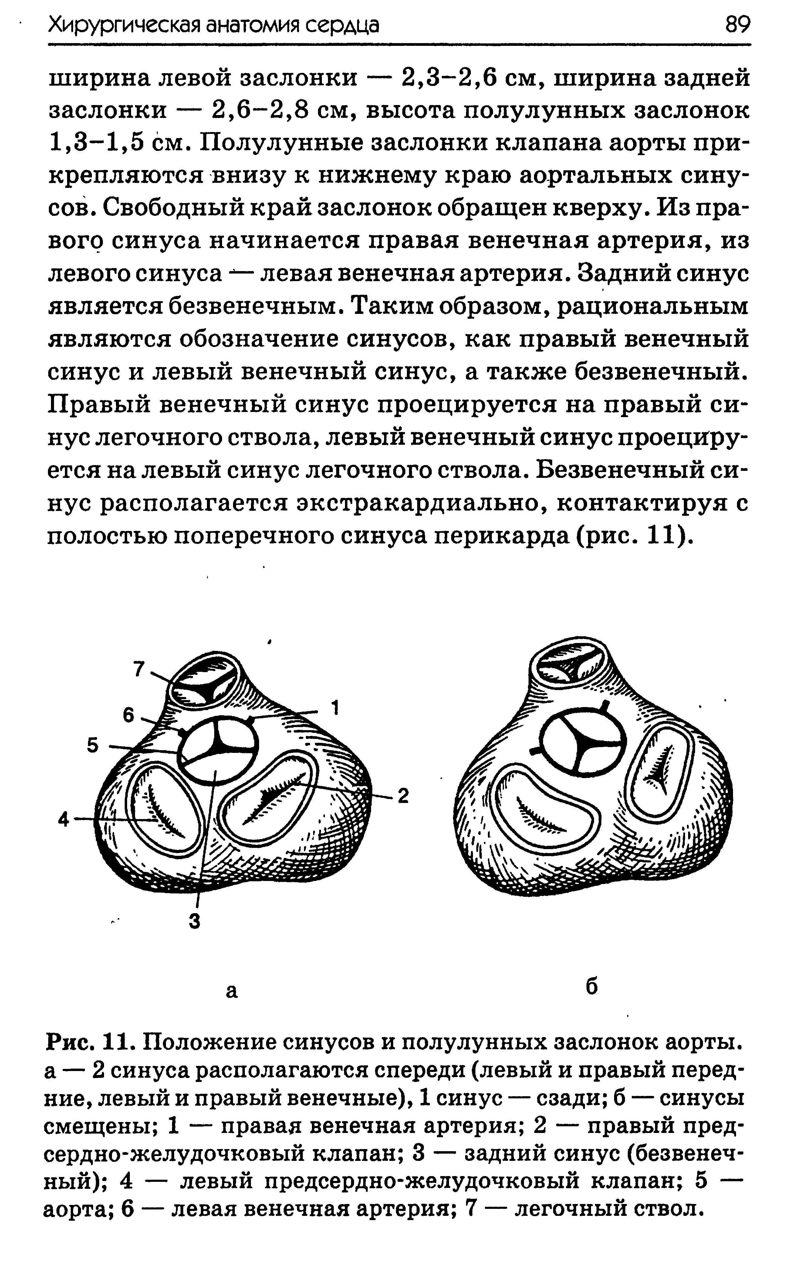 Рис. 11. Положение синусов и полулунных заслонок аорты, а — 2 синуса располагаются спереди (левый и правый передние, левый и правый венечные), 1 синус — сзади б — синусы смещены 1 — правая венечная артерия 2 — правый предсердно-желудочковый клапан 3 — задний синус (безвенечный) 4 — левый предсердно-желудочковый клапан 5 — аорта 6 — левая венечная артерия 7 — легочный ствол.