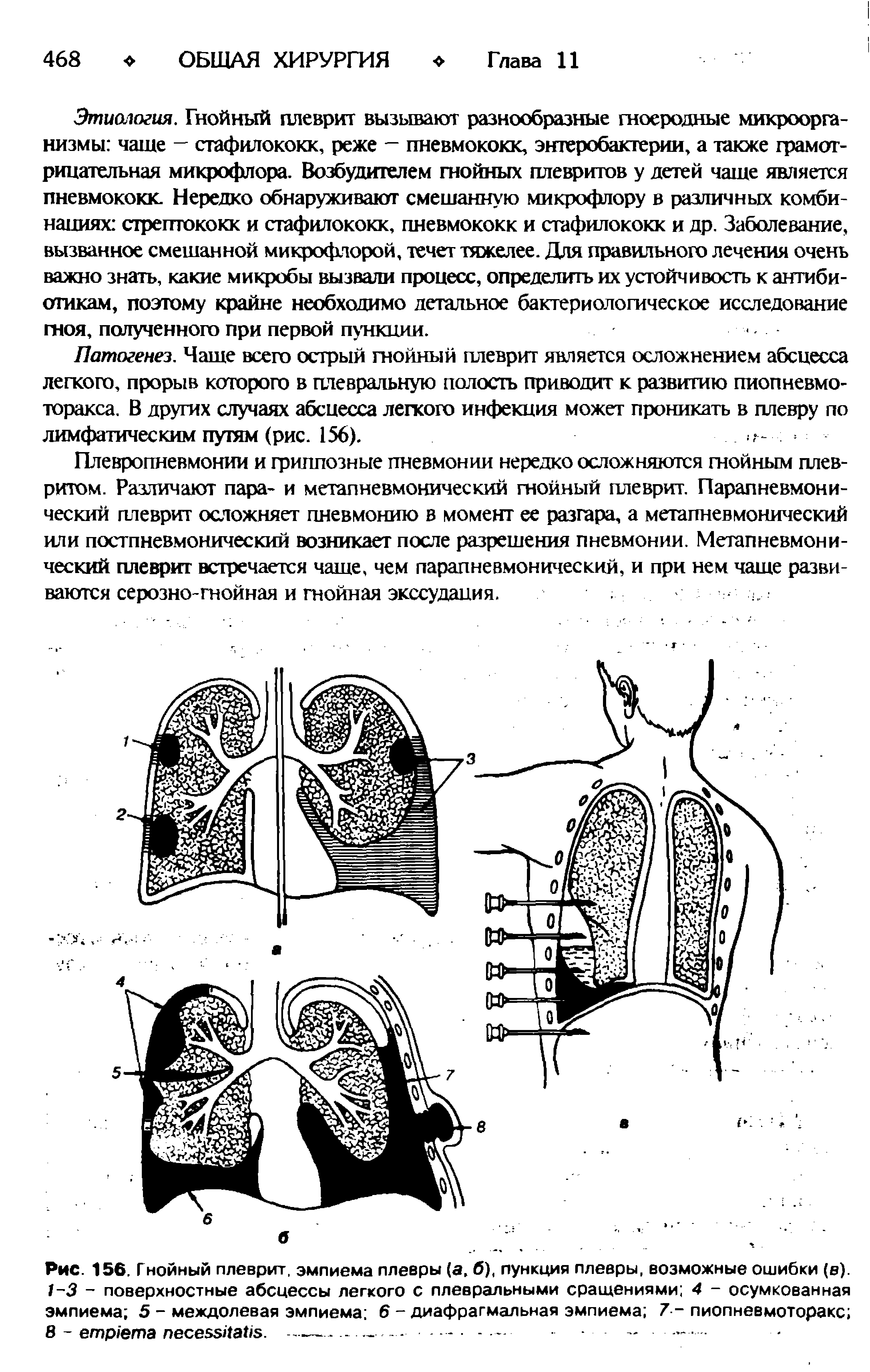 Рис. 156. Гнойный плеврит, эмпиема плевры (а, б), пункция плевры, возможные ошибки (в). 1-3 - поверхностные абсцессы легкого с плевральными сращениями 4 - осумкованная эмпиема 5 - междолевая эмпиема 6 - диафрагмальная эмпиема 7 - пиопневмоторакс В - . ---------- - - - - - —...