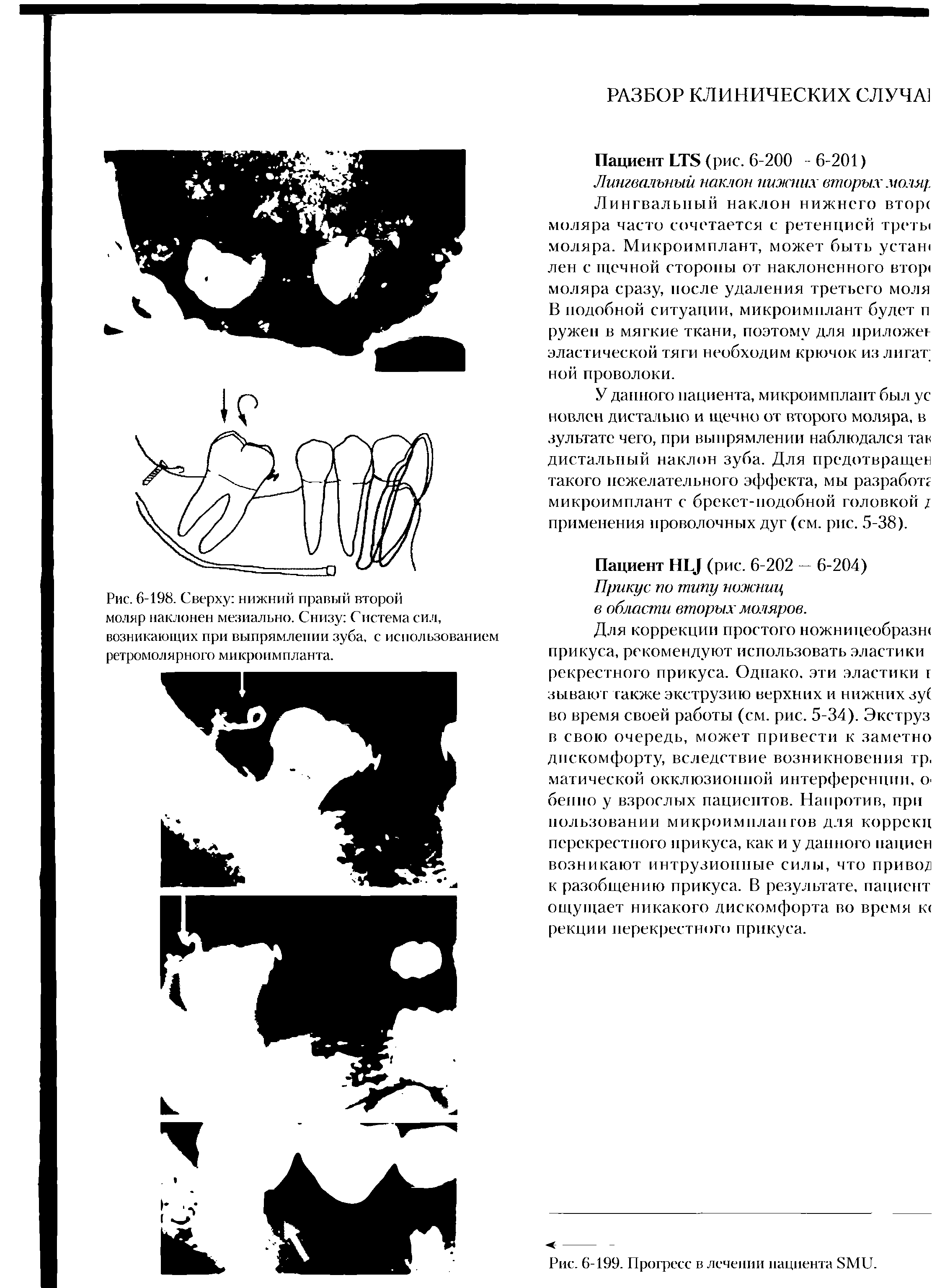 Рис. 6-198. Сверху нижний правый второй моляр наклонен медиально. Снизу Система сил, возникающих при выпрямлении зуба, с использованием ретромолярного микроимпланта.