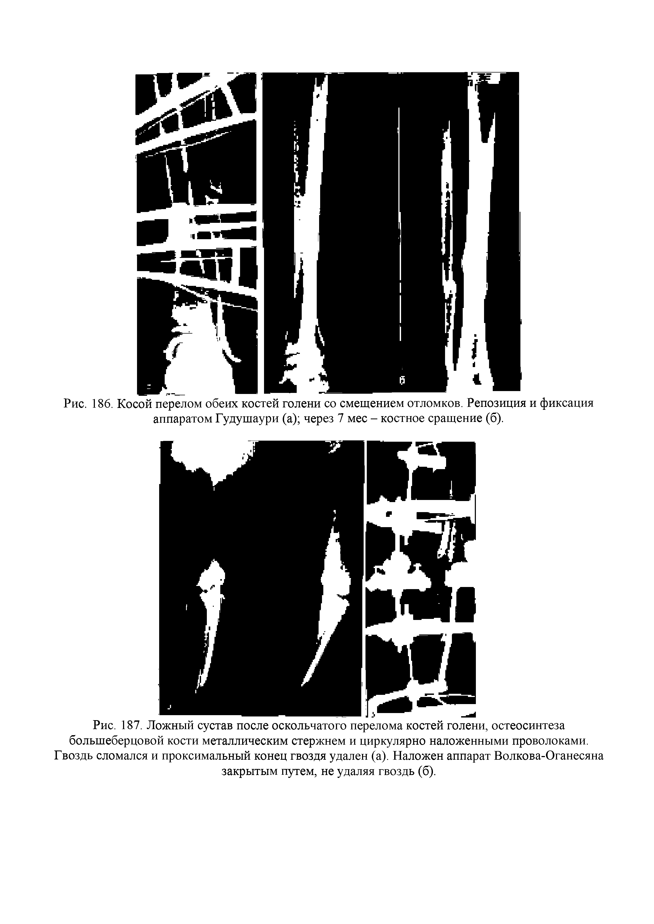 Рис. 187. Ложный сустав после оскольчатого перелома костей голени, остеосинтеза большеберцовой кости металлическим стержнем и циркулярно наложенными проволоками. Гвоздь сломался и проксимальный конец гвоздя удален (а). Наложен аппарат Волкова-Оганесяна закрытым путем, не удаляя гвоздь (б).