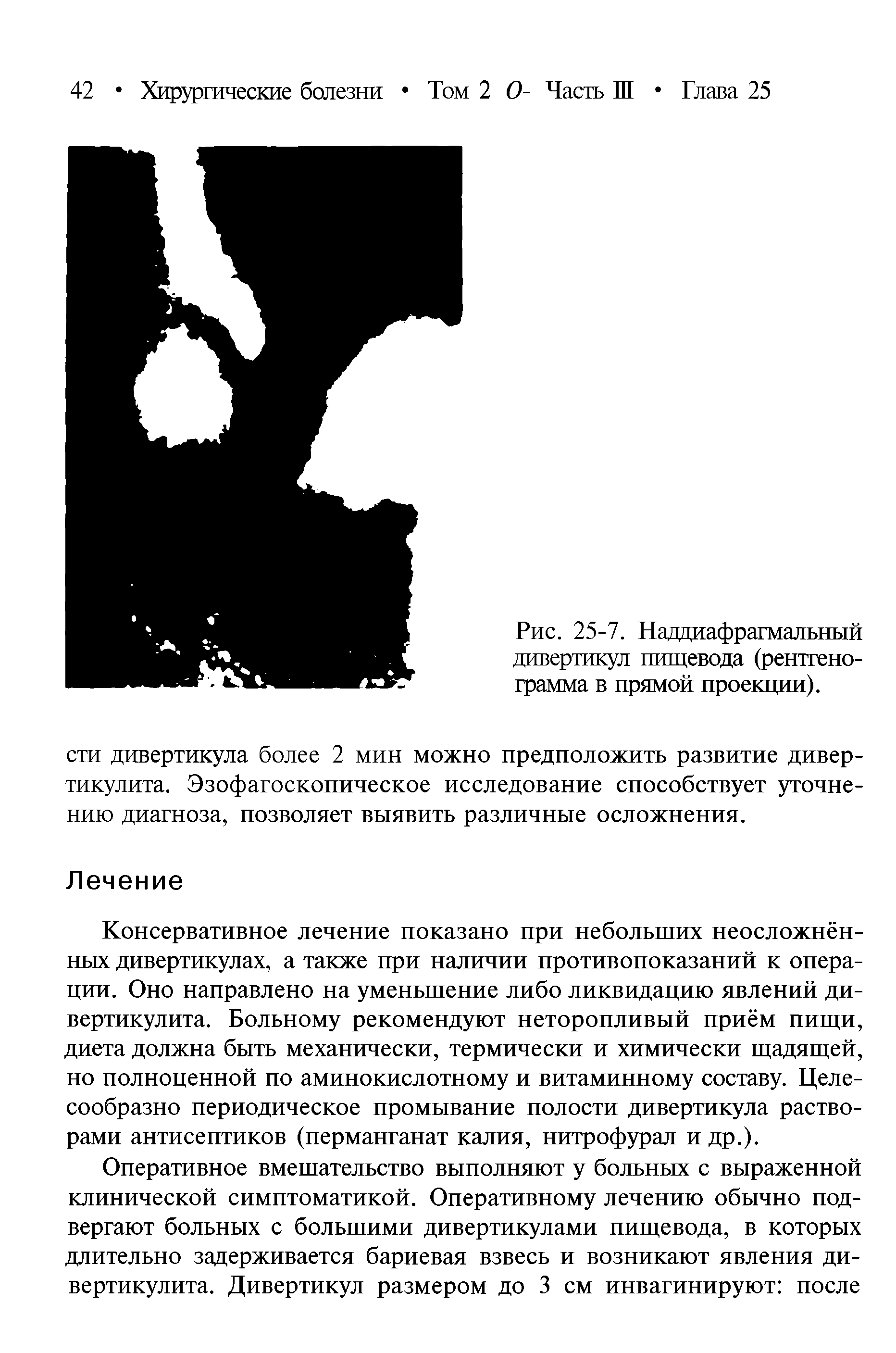 Рис. 25-7. Наддиафрагмальный дивертикул пищевода (рентгенограмма в прямой проекции).