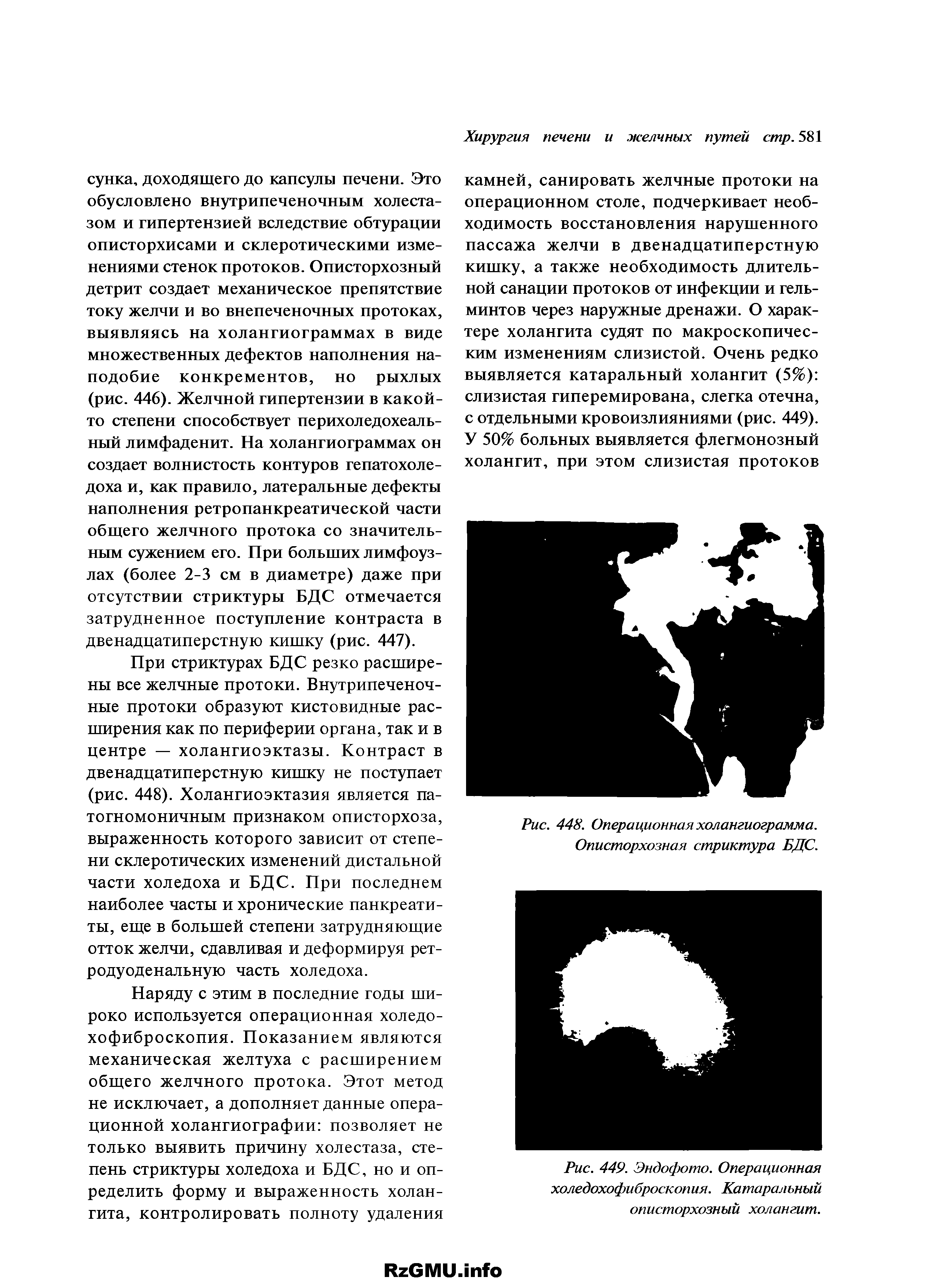 Рис. 449. Эндофото. Операционная холедохофиброскопия. Катаральный описторхозный холангит.