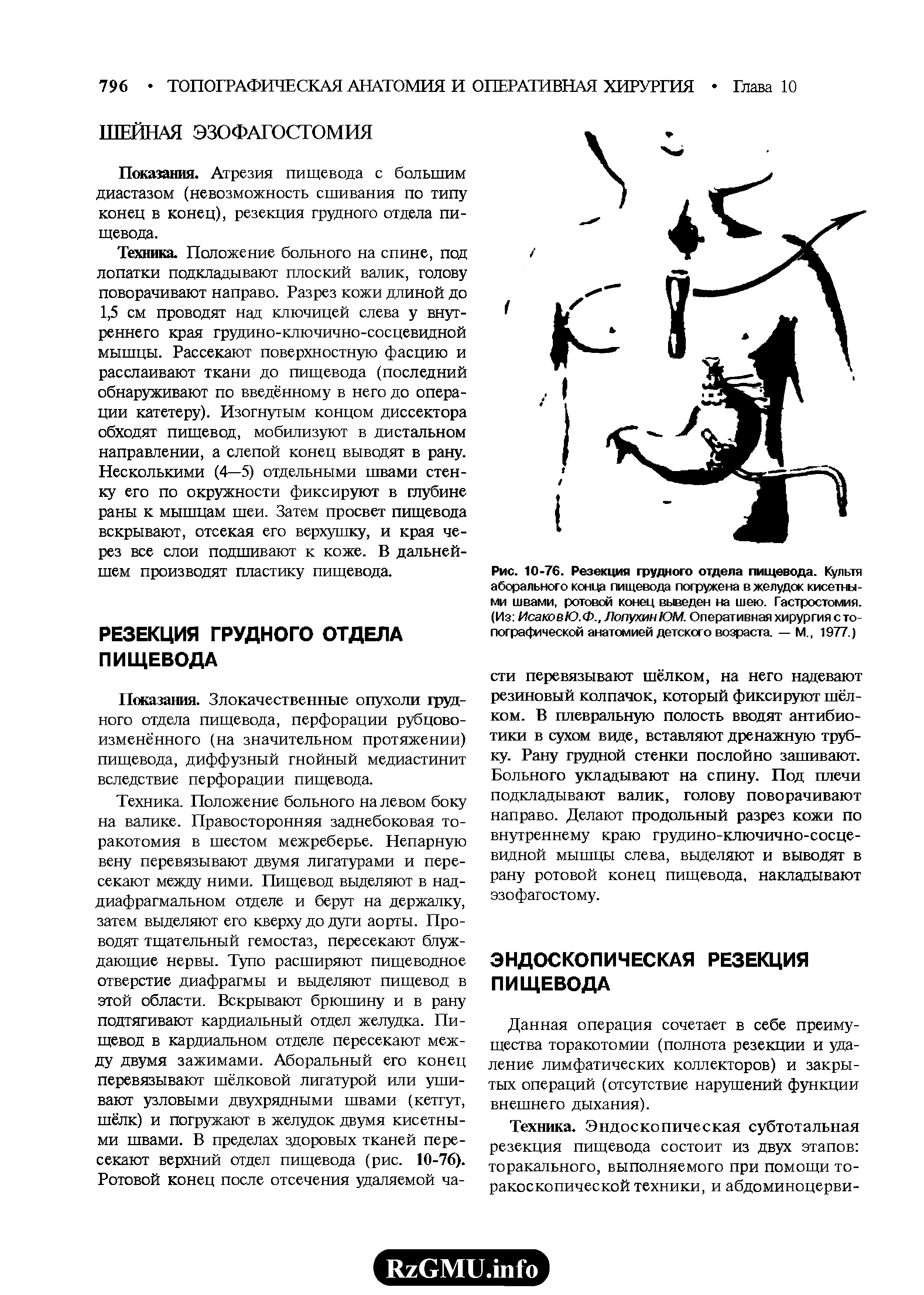 Рис. 10-76. Резекция грудного отдела пищевода. Культя аборального конца пищевода погружена в желудок кисетными швами, ротовой конец выведен на шею. Гастростомия. (Из ИсаковЮ.Ф., Лопухин ЮМ. Оперативная хирургия с топографической анатомией детского возраста. — М., 1977.)...