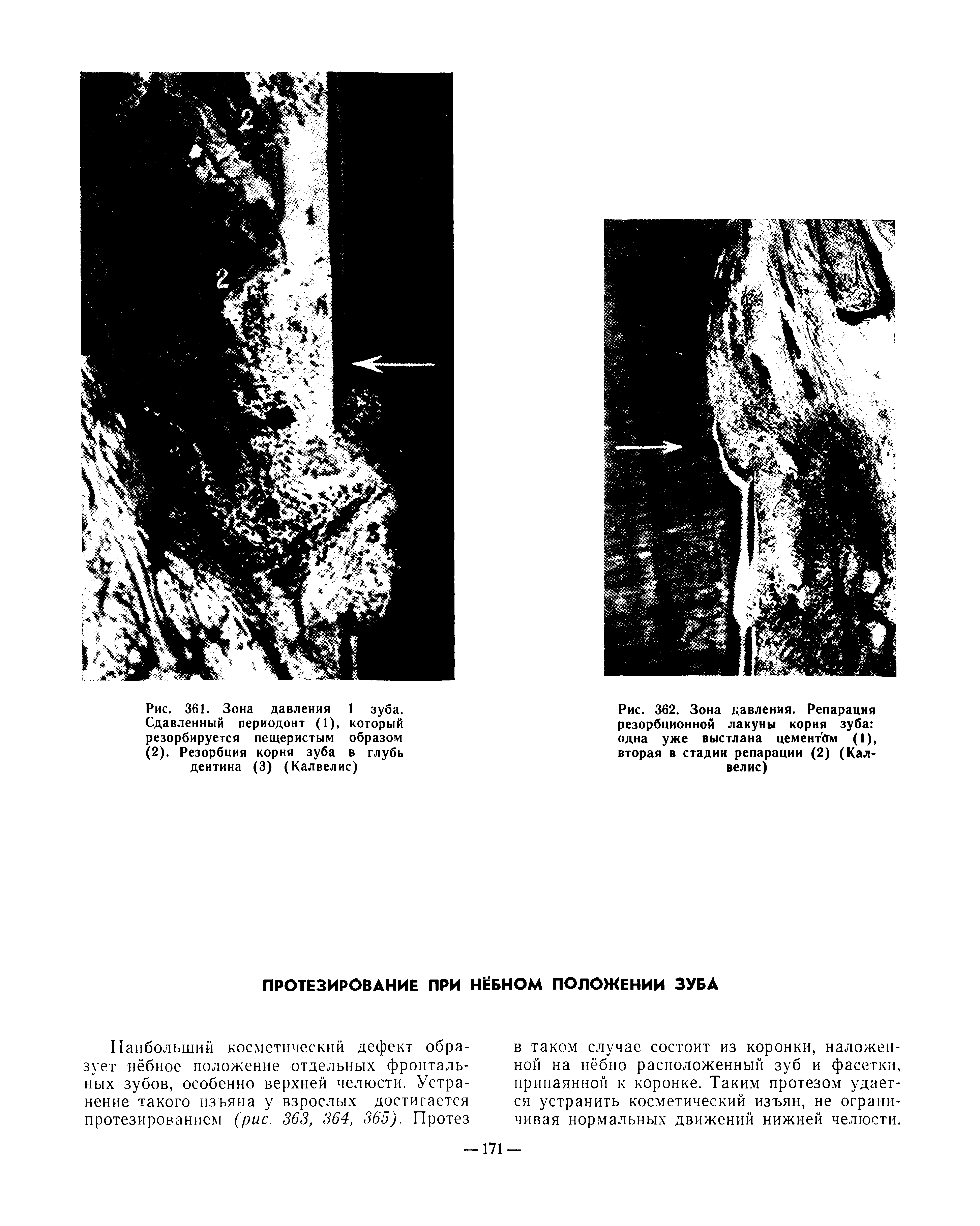 Рис. 362. Зона давления. Репарация резорбционной лакуны корня зуба одна уже выстлана цементом (1), вторая в стадии репарации (2) (Кал велис)...