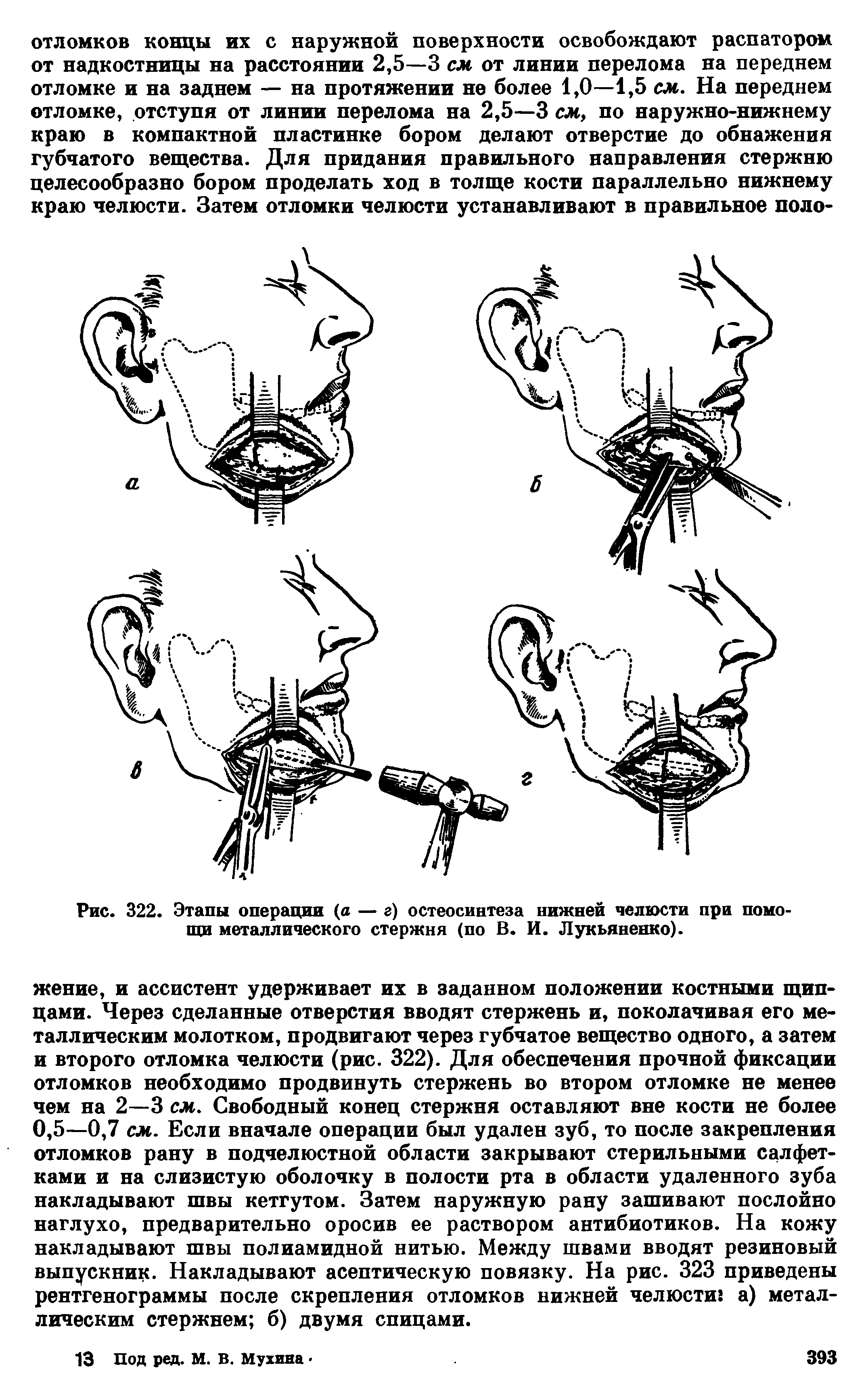 Рис. 322. Этапы операции (а — г) остеосинтеза нижней челюсти при помощи металлического стержня (по В. И. Лукьяненко).