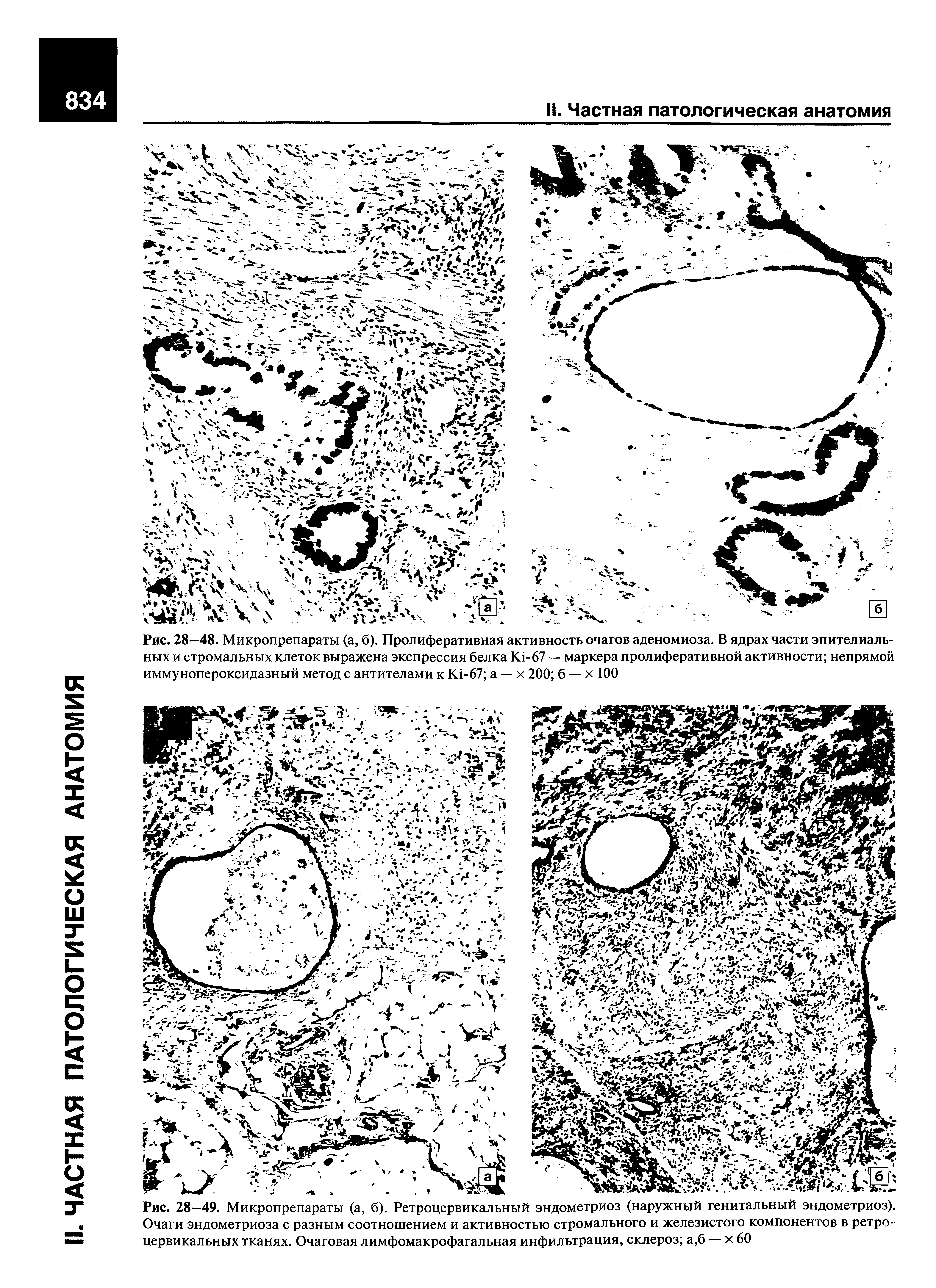 Рис. 28—48. Микропрепараты (а, б). Пролиферативная активность очагов аденомиоза. В ядрах части эпителиальных и стромальных клеток выражена экспрессия белка K -67 — маркера пролиферативной активности непрямой иммунопероксидазный метод с антителами к K -67 а — х 200 б — х 100...