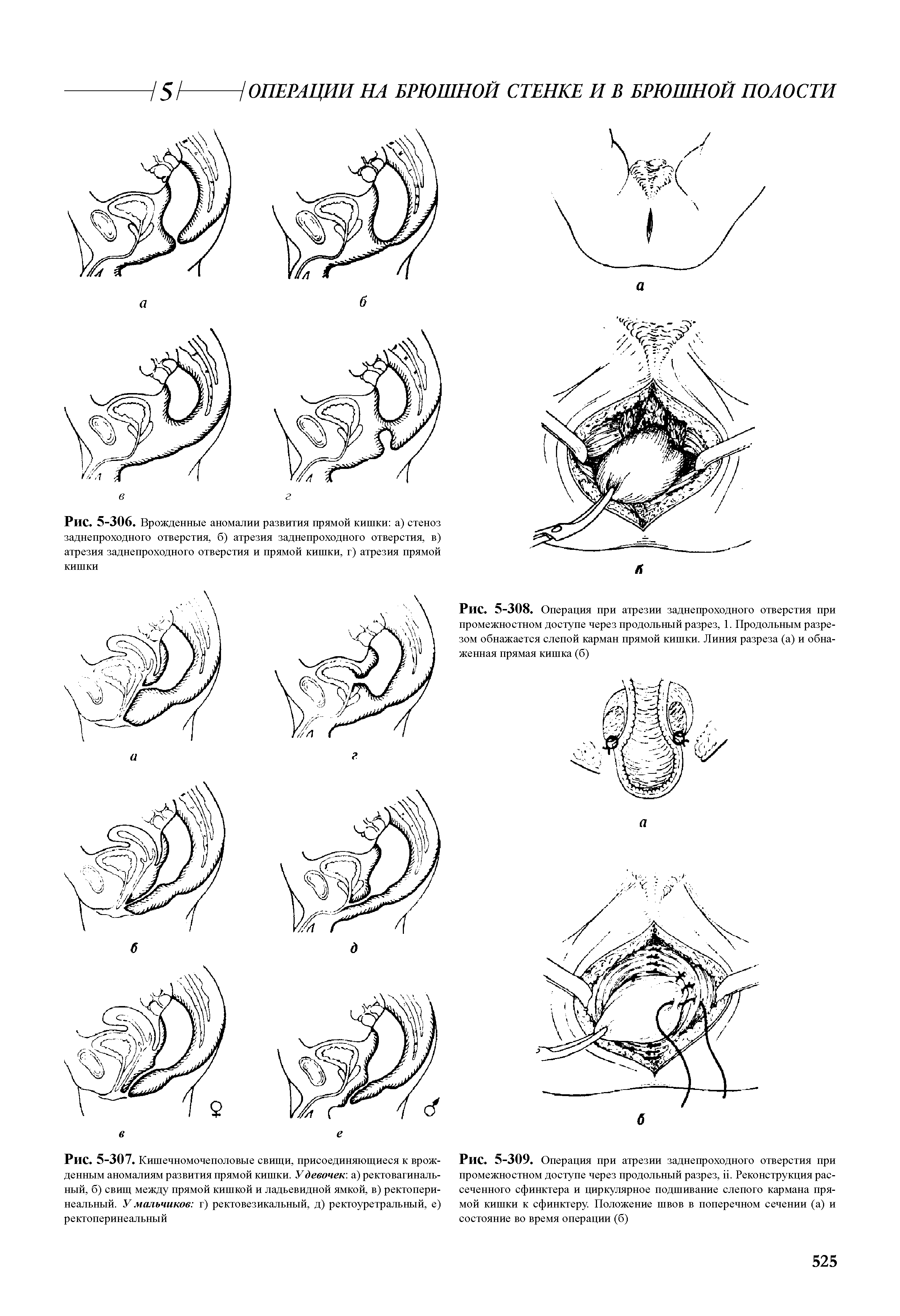 Рис. 5-306. Врожденные аномалии развития прямой кишки а) стеноз заднепроходного отверстия, б) атрезия заднепроходного отверстия, в) атрезия заднепроходного отверстия и прямой кишки, г) атрезия прямой кишки...