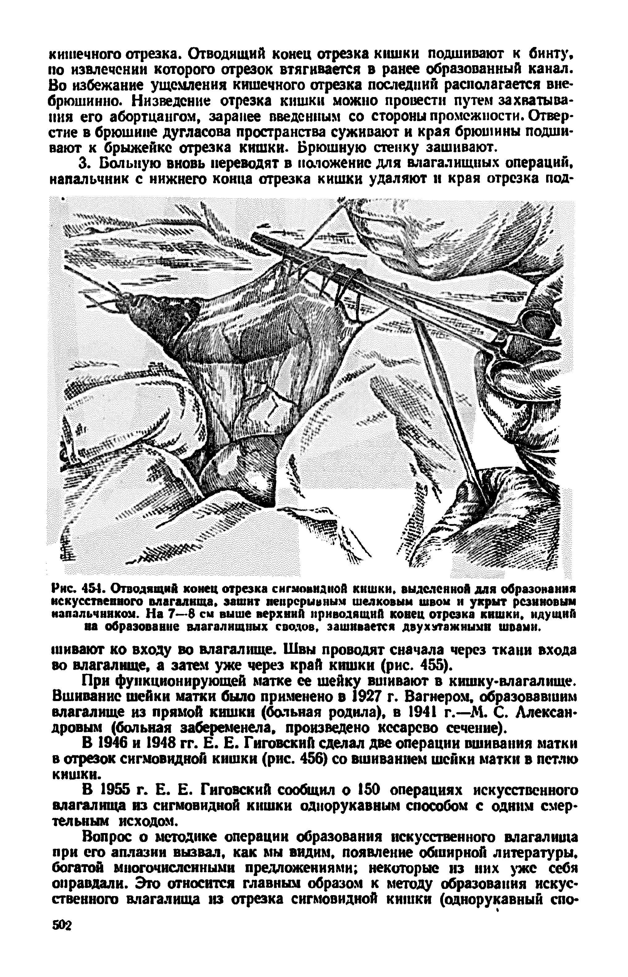 Рис. 45-1. Отводящий конец отрезка сигмовидной кишки, выделенной для образования искусственного влагалища, зашит непрерывным шелковым швом н укрыт резиновым напальчником. На 7—8 см выше верхний приводящий конец отрезка кишки, идущий на образование влагалищных сводов, зашивается двухэтажными швами.